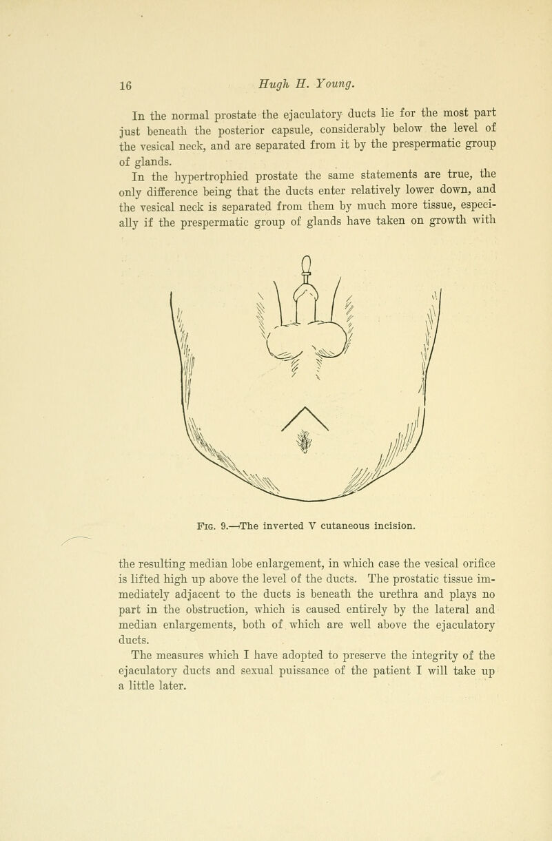 In the normal prostate the ejaculatory ducts lie for the most part just beneath the posterior capsule, considerably below the level of the vesical neck, and are separated from it by the prespermatic group of glands. In the hypertrophied prostate the same statements are true, the only difference being that the ducts enter relatively lower down, and the vesical neck is separated from them by much more tissue, especi- ally if the prespermatic group of glands have taken on growth with Fig. 9.—iThe inverted V cutaneous incision. the resulting median lobe enlargement, in which case the vesical orifice is lifted high up above the level of the ducts. The prostatic tissue im- mediately adjacent to the ducts is beneath the urethra and plays no part in the obstruction, which is caused entirely by the lateral and median enlargements, both of which are well above the ejaculatory duets. The measures which I have adopted to preserve the integrity of the ejaculatory ducts and sexual puissance of the patient I will take up a little later.