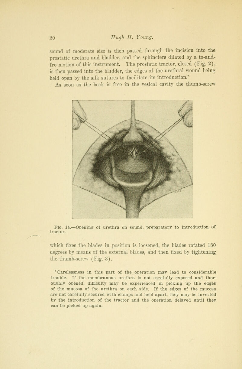 sound of moderate size is then passed through the incision into the prostatic urethra and bladder, and the sphincters dilated by a to-and- fro motion of this instrument. The prostatic tractor, closed (Fig. 2), is then passed into the bladder, the edges of the urethral wound being held open by the silk sutures to facilitate its introduction.' As soon as the beak is free in the vesical cavity the thumb-screw Fig. 14.—Opening of urethra on sound, preparatory to introduction of tractor. which fixes the blades in position is loosened, the blades rotated 180 degrees by means of the external blades, and then fixed by tightening the thumb-screw (Fig. 3). ^ Carelessness in this part of the operation may lead to considerable trouble. If the membranous urethra is not carefully exposed and thor- oughly opened, difficulty may be experienced in picking up the edges of the mucosa of the urethra on each side. If the edges of the mucosa are not carefully secured with clamps and held apart, they may be inverted by the introduction of the tractor and the operation delayed until they can be picked up again.