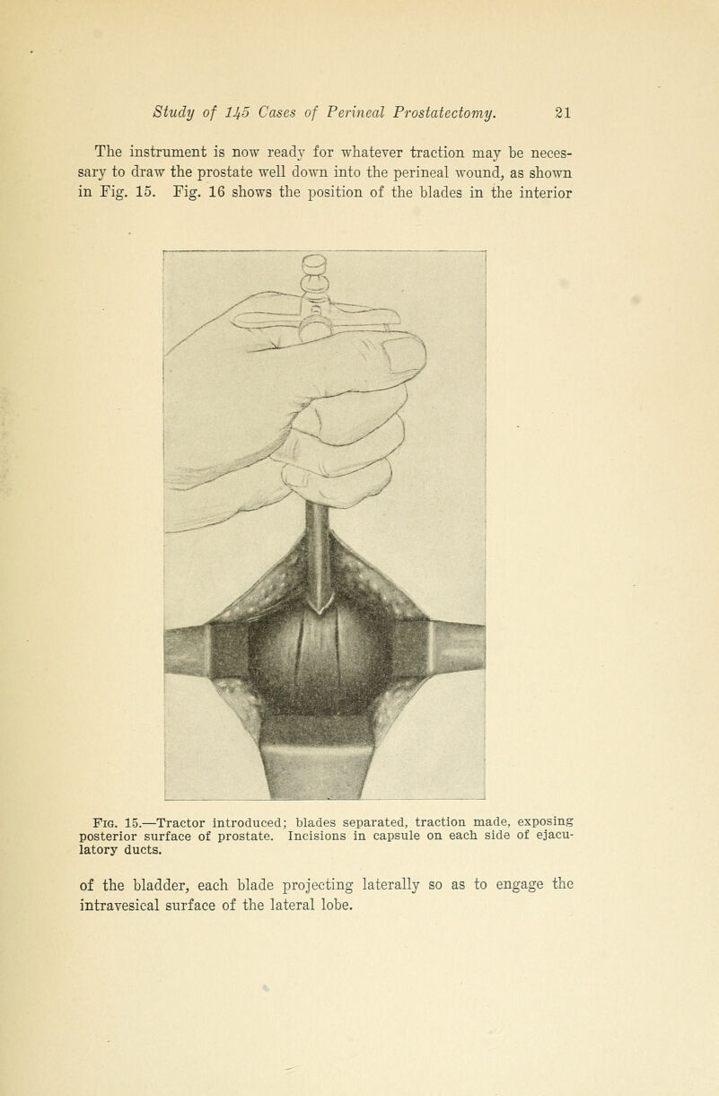 The instrument is now ready for whatever traction may be neces- sary to draw the prostate well down into the perineal wound, as shown in Fig. 15. Fig. 16 shows the position of the blades in the interior Fig. 15.—Tractor introduced; blades separated, traction made, exposing posterior surface of prostate. Incisions in capsule on each, side of ejacu- latory ducts. of the bladder, each blade projecting laterally so as to engage the intravesical surface of the lateral lobe.