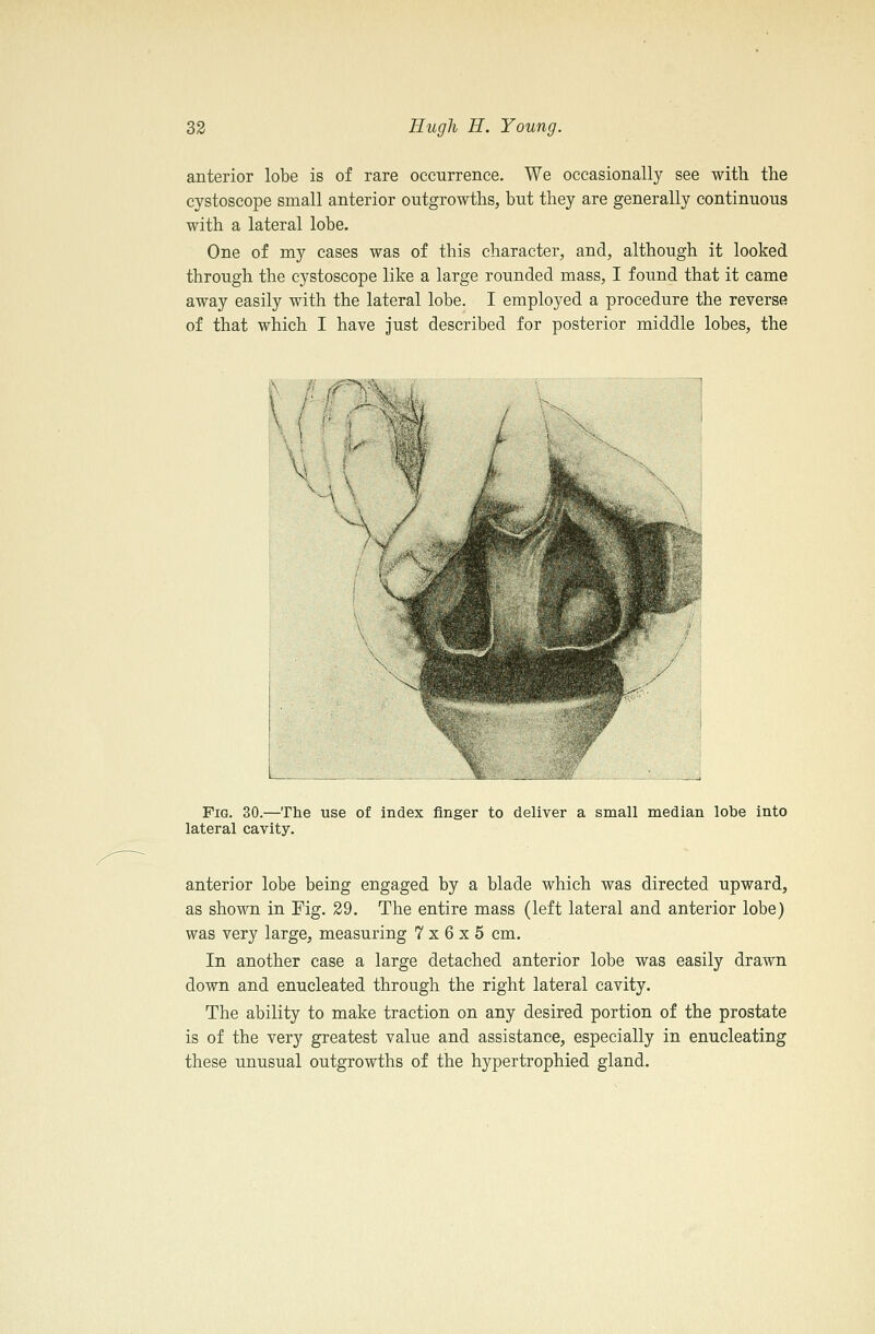 anterior lobe is of rare occurrence. We occasionally see with the cystoscope small anterior outgrowths, but they are generally continuous with a lateral lobe. One of my cases was of this character, and, although it looked through the cystoscope like a large rounded mass, I found that it came away easily with the lateral lobe. I employed a procedure the reverse of that which I have just described for posterior middle lobes, the Fig. 30.—The use of index finger to deliver a small median lobe into lateral cavity. anterior lobe being engaged by a blade which was directed upward, as shown in Fig. 29. The entire mass (left lateral and anterior lobe) was very large, measuring 7x6x5 cm. In another case a large detached anterior lobe was easily drawn down and enucleated through the right lateral cavity. The ability to make traction on any desired portion of the prostate is of the very greatest value and assistance, especially in enucleating these unusual outgrowths of the hypertrophied gland.