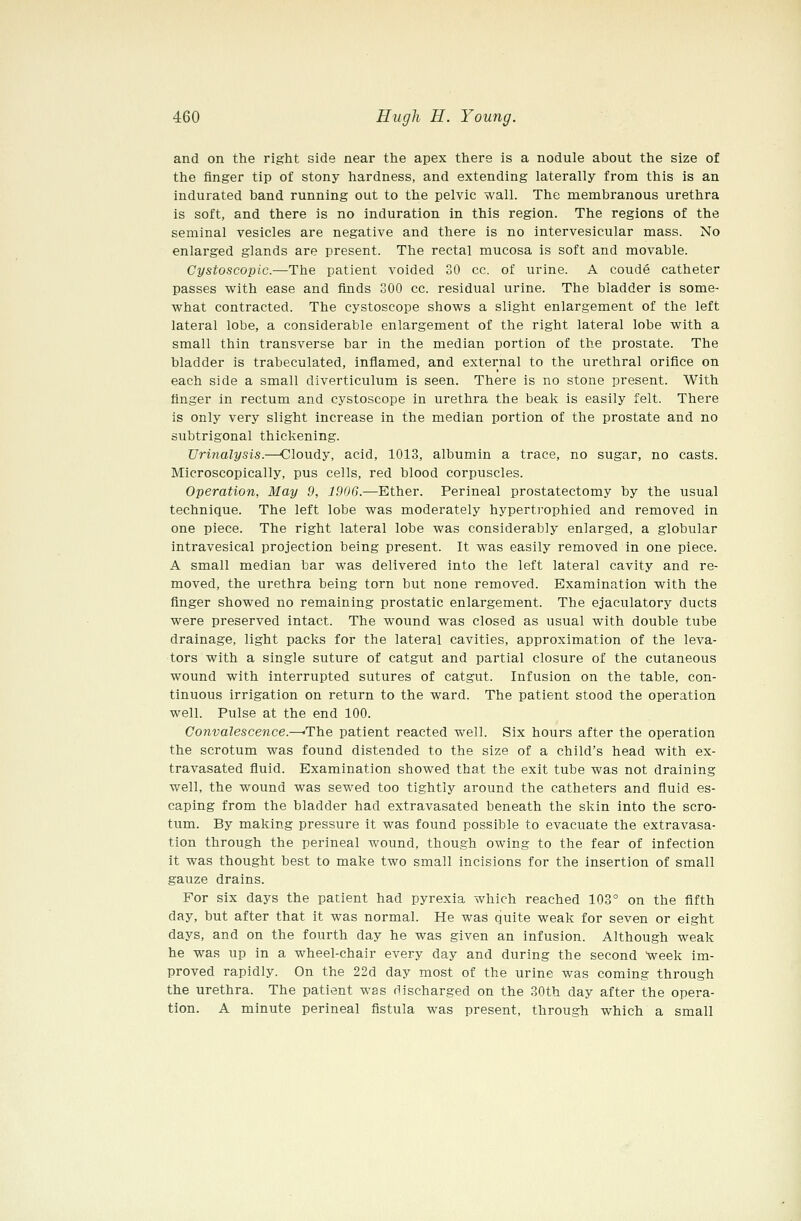 and on the right side near the apex there is a nodule about the size of the finger tip of stony hardness, and extending laterally from this is an Indurated band running out to the pelvic wall. The membranous urethra is soft, and there is no induration in this region. The regions of the seminal vesicles are negative and there is no intervesicular mass. No enlarged glands are present. The rectal mucosa is soft and movable. Cystoscoplc.—The patient voided 30 cc. of urine. A coude catheter passes with ease and finds 300 cc. residual urine. The bladder is some- what contracted. The cystoscope shows a slight enlargement of the left lateral lobe, a considerable enlargement of the right lateral lobe with a small thin transverse bar in the median portion of the prostate. The bladder is trabeculated, inflamed, and external to the urethral orifice on each side a small diverticulum is seen. There is no stone present. With finger in rectum and cystoscope in urethra the beak is easily felt. There is only very slight increase in the median portion of the prostate and no subtrigonal thickening. Urinalysis.—Cloudy, acid, 1013, albumin a trace, no sugar, no casts. Microscopically, pus cells, red blood corpuscles. Operation, May 9, 1906.—Ether. Perineal prostatectomy by the usual technique. The left lobe was moderately hypertrophied and removed in one piece. The right lateral lobe was considerably enlarged, a globular intravesical projection being present. It was easily removed in one piece. A small median bar was delivered into the left lateral cavity and re- moved, the urethra being torn but none removed. Examination with the finger showed no remaining prostatic enlargement. The ejaculatory ducts were preserved intact. The wound was closed as usual with double tube drainage, light packs for the lateral cavities, approximation of the leva- tors with a single suture of catgut and partial closure of the cutaneous wound with interrupted sutures of catgut. Infusion on the table, con- tinuous irrigation on return to the ward. The patient stood the operation well. Pulse at the end 100. Convalescence.—<The patient reacted well. Six hours after the operation the scrotum was found distended to the size of a child's head with ex- travasated fluid. Examination showed that the exit tube was not draining well, the wound was sewed too tightly around the catheters and fluid es- caping from the bladder had extravasated beneath the skin into the scro- tum. By making pressure it was found possible to evacuate the extravasa- tion through the perineal wound, though owing to the fear of infection it was thought best to make two small incisions for the insertion of small gauze drains. For six days the patient had pyrexia which reached 103° on the fifth day, but after that it was normal. He was quite weak for seven or eight days, and on the fourth day he was given an infusion. Although weak he was up in a wheel-chair every day and during the second 'week im- proved rapidly. On the 22d day most of the urine was coming through the urethra. The patient was discharged on the 30th day after the opera- tion. A minute perineal fistula was present, through which a small