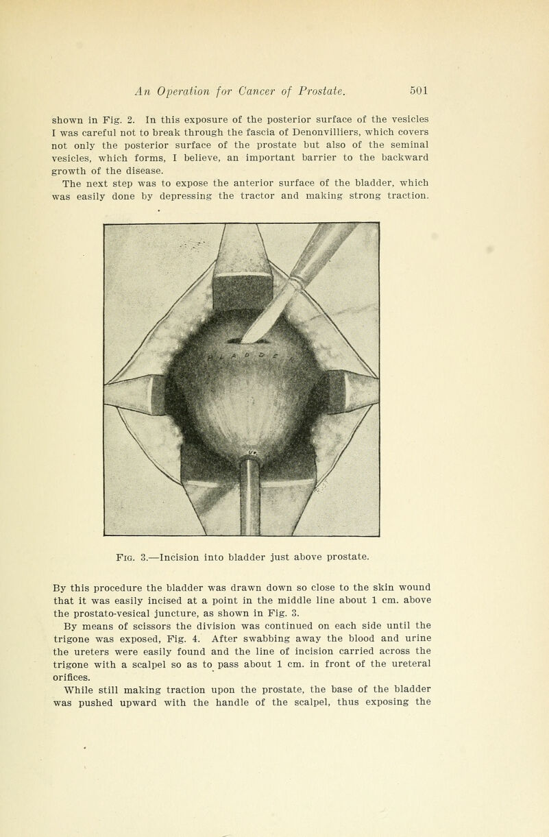 shown in Fig. 2. In this exposure of the posterior surface of the vesicles I was careful not to break through the fascia of Denonvilliers, which covers not only the posterior surface of the prostate but also of the seminal vesicles, which forms, I believe, an important barrier to the backward growth of the disease. The next step was to expose the anterior surface of the bladder, which was easily done by depressing the tractor and making strong traction. /^ ' \ ^\ // • v.^^B PIBF' m\ ■^^-—^ m^^K^^ ^BK ■^mM. -^ ^■■ifiB^^^^^K, // ^^^^^^^HB ^y f f? f M / Fig. 3.—Incision into bladder just above prostate. By this procedure the bladder was drawn down so close to the skin wound that it was easily incised at a point in the middle line about 1 cm. above the prostato-vesical juncture, as shown in Fig. 3. By means of scissors the division was continued on each side until the trigone was exposed. Fig. 4. After swabbing away the blood and urine the ureters were easily found and the line of incision carried across the trigone with a scalpel so as to pass about 1 cm. in front of the ureteral orifices. While still making traction upon the prostate, the base of the bladder was pushed upward with the handle of the scalpel, thus exposing the