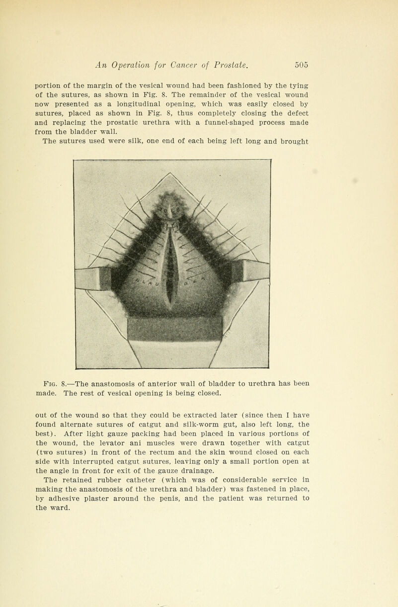 portion of the margin of the vesical wound had been fashioned by the tying of the sutures, as shown in Fig. 8. The remainder of the vesical wound now presented as a longitudinal opening, which was easily closed by sutures, placed as shown in Fig. 8, thus completely closing the defect and replacing the prostatic urethra with a funnel-shaped process made from the bladder wall. The sutures used were silk, one end of each being left long and brought Fig. 8.—The anastomosis of anterior wall of bladder to urethra has been made. The rest of vesical opening is being closed. out of the wound so that they could be extracted later (since then I have found alternate sutures of catgut and silk-worm gut, also left long, the best). After light gauze packing had been placed in various portions of the wound, the levator ani muscles were drawn together with catgut (two sutures) in front of the rectum and the skin wound closed on each side with interrupted catgut sutures, leaving only a small portion open at the angle in front for exit of the gauze drainage. The retained rubber catheter (which was of considerable service in making the anastomosis of the urethra and bladder) was fastened in place, by adhesive plaster around the penis, and the patient was returned to the ward.