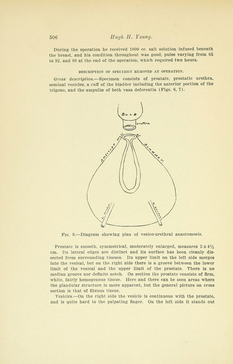 During the operation he received 1000 cc. salt solution infused beneath the breast, and his condition throughout was good, pulse varying from 65 to 92, and SO at the end of the operation, which required two hours. DESCKIPTION OF SPECIMEN BEMOVED AT OPERATION. Oross description.—Specimen consists of prostate, prostatic urethra, seminal vesicles, a cuff of the bladder including the anterior portion of the trigone, and the ampullae of both vasa deferentia (Figs. 6, 7). Fig. 9.—Diagram showing plan of vesico-urethral anastomosis. Prostate is smooth, symmetrical, moderately enlarged, measures 5 x 41/4 cm. Its lateral edges are distinct and its surface has been cleanly dis- sected from surrounding tissues. Its upper limit on the left side merges into the vesical, but on the right side there is a groove between the lower limit of the vesical and the upper limit of the prostate. There is no median groove nor definite notch. On section the prostate consists of firm, white, fairly homogenous tissue. Here and there can be seen areas where the glandular structure is more apparent, but the general picture on cross section is that of fibrous tissue. Vesicles.—On the right side the vesicle is continuous with the prostate, and is quite hard to the palpating finger. On the left side it stands out