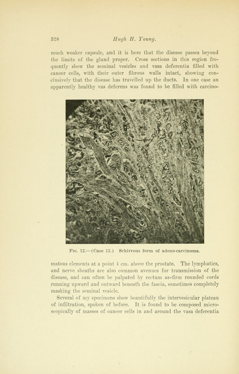 much weaker capsule, and it is here that the disease passes beyond the limits of the gland proper. Cross sections in this region fre- quently show the seminal vesicles and vasa deferentia filled with cancer cells, with their outer fibrous walls intact, showing con- clusively that the disease has travelled up the ducts. In one case an apparently healthy vas deferens was found to be filled with carcino- T^'jp***^^- ^ Fig. 12.— (Case 13.) Schirrous form of adeno-carcinoma. matous elements at a point i cm. above the prostate. The lymphatics, and nerve sheaths are also common avenues for transmission of the disease, and can often be palpated by rectum as-firm rounded cords running upward and outward beneath the fascia, sometimes completely masking the seminal vesicle. Several of my specimens show beautifully the intervesicular plateau of infiltration, spoken of before. It is found to be composed micro- scopically of masses of cancer cells in and around the vasa deferentia