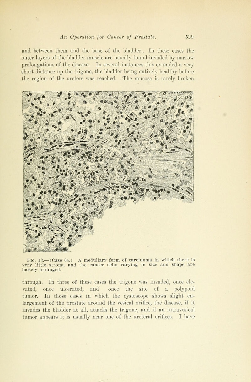 and between them and the base of the bladder.. In these cases the outer layers of the bladder muscle are usually found invaded by narrow prolongations of the disease. In several instances this extended a very short distance up the trigone, the bladder being entirely healthy before the region of the ureters was reached. The mucosa is rarely broken Fig. 13.— (Case 64.) A medullary form of carcinoma in which there is very little stroma and the cancer cells varying in size and shape are loosely arranged. through. In three of these cases the trigone was invaded, once ele- vated, once ulcerated, and once the site of a polypoid tumor. In those cases in which the cystoscope shows slight en- largement of the prostate around the vesical orifice, the disease, if it invades the bladder at all, attacks the trigone, and if an intravesical tumor appears it is usually near one of the ureteral orifices. I have