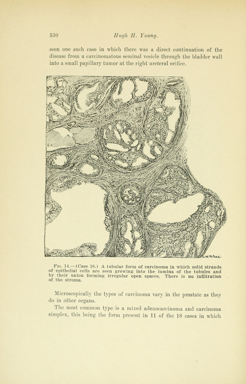 seen one such case in which there was a direct continuation of the disease from a carcinomatous seminal vesicle through the bladder wall into a small papillary tumor at the right ureteral orifice. TN!N.r<i«.d.. Fig. 14.— (Case 10.) A tubular form of carcinoma in which solid strands of epithelial cells are seen growing into the lumina of the tubules and by their union forming irregular open spaces. There is no infiltration of the stroma. Microscopically the types of carcinoma vary in the prostate as they do in other organs. The most common type is a mixed adenocarcinoma and carcinoma simplex, this being the form present in 11 of the 18 cases in which