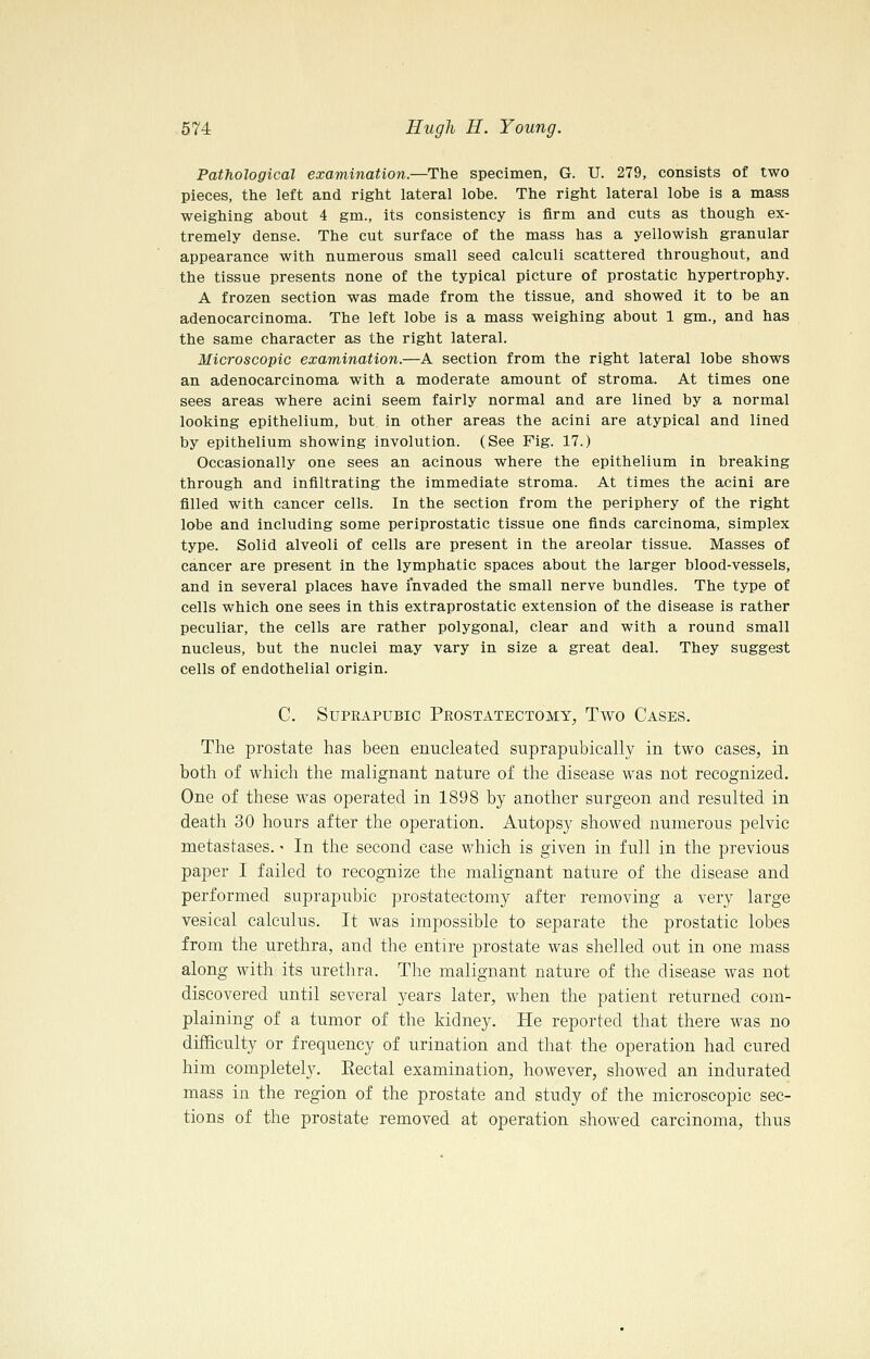 Pathological examination.—The specimen, G. U. 279, consists of two pieces, the left and right lateral lobe. The right lateral lobe is a mass weighing about 4 gm., its consistency is firm and cuts as though ex- tremely dense. The cut surface of the mass has a yellowish granular appearance with numerous small seed calculi scattered throughout, and the tissue presents none of the typical picture of prostatic hypertrophy. A frozen section was made from the tissue, and showed it to be an adenocarcinoma. The left lobe is a mass weighing about 1 gm., and has the same character as the right lateral. Microscopic examination.—A section from the right lateral lobe shows an adenocarcinoma with a moderate amount of stroma. At times one sees areas where acini seem fairly normal and are lined by a normal looking epithelium, but in other areas the acini are atypical and lined by epithelium showing involution. (See Fig. 17.) Occasionally one sees an acinous where the epithelium in breaking through and infiltrating the immediate stroma. At times the acini are filled with cancer cells. In the section from the periphery of the right lobe and including some periprostatic tissue one finds carcinoma, simplex type. Solid alveoli of cells are present in the areolar tissue. Masses of cancer are present in the lymphatic spaces about the larger blood-vessels, and in several places have invaded the small nerve bundles. The type of cells which one sees in this extraprostatic extension of the disease is rather peculiar, the cells are rather polygonal, clear and with a round small nucleus, but the nuclei may vary in size a great deal. They suggest cells of endothelial origin. C. SuPEAPUBic Peostatectomy, Two Cases. The prostate has been enucleated suprapubically in two cases, in both of which the malignant nature of the disease was not recognized. One of these was operated in 1898 by another surgeon and resulted in death 30 hours after the operation. Autopsy showed numerous pelvic metastases. • In the second case which is given in full in the previous paper I failed to recognize the malignant nature of the disease and performed suprapubic prostatectomy after removing a very large vesical calculus. It was impossible to separate the prostatic lobes from the urethra, and the entire prostate was shelled out in one mass along with its urethra. The malignant nature of the disease was not discovered until several years later, when the patient returned com- plaining of a tumor of the kidney. He reported that there was no difficulty or frequency of urination and that the operation had cured him completely. Eectal examination, however, showed an indurated mass in the region of the prostate and study of the microscopic sec- tions of the prostate removed at operation showed carcinoma, thus