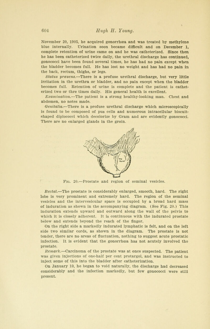 November 20, 1905, he acquired gonorrhoea and was treated by methylene blue internally. Urination soon became difficult and on December 1, complete retention of urine came on and he was catheterized. Since then he has been catheterized twice daily, the urethral discharge has continued, gonococci have been found several times, he has had no pain except when the bladder becomes full. He has lost no weight and has had no pain in the back, rectum, thighs, or legs. Status 'prcEsens.—There is a profuse urethral discharge, but very little irritation in the urethra or bladder, and no pain except when the bladder becomes full. Retention of urine is complete and the patient is cathet- erized two or thre times daily. His general health is excellent. Examination.—The patient is a strong healthy-looking man. Chest and abdomen, no notes made. Genitalia.—There is a profuse urethral discharge which microscopically is found to be composed of pus cells and numerous intracellular biscuit- shaped diplococci which decolorize by Gram and are evidently gonococci. There are no enlarged glands in the groin. Fig. 20.—Prostate and region of seminal vesicles. Rectal.—The prostate is considerably enlarged, smooth, hard. The right lobe is very prominent and extremely hard. The region of the seminal vesicles and the intervesicular space is occupied by a broad hard mass of induration as shown in the accompanying diagram. (See Fig. 20.) This induration extends upward and outward along the wall of the pelvis to which it is closely adherent. It is continuous with the indurated prostate below and extends beyond the reach of the finger. On the right side a markedly indurated lymphatic is felt, and on the left side two similar cords, as shown in the diagram. The prostate is not tender, there are no areas of fluctuation, nothing to suggest acute prostatic infection. It is evident that the gonorrhoea has not acutely involved the prostate. Remark.—Carcinoma of the prostate was at once suspected. The patient was given injections of one-half per cent protargol, and was instructed to inject some of this into the bladder after catheterization. On January 10, he began to void naturally, the discharge had decreased considerably and the infection markedly, but few gonococci were still present.