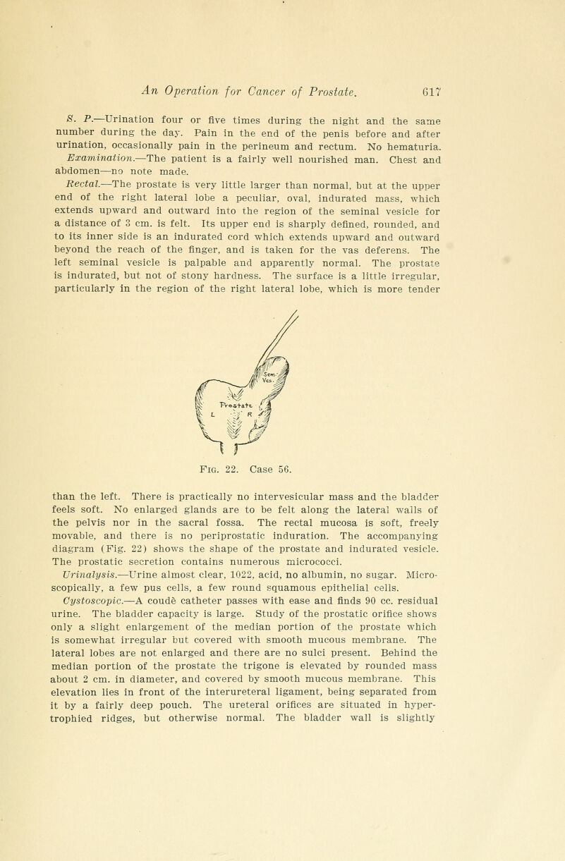 ^- P-—Urination four or five times during the night and the same number during the day. Pain in the end of the penis before and after urination, occasionally pain in the perineum and rectum. No hematuria. Examination.—The patient is a fairly well nourished man. Chest and abdomen—no note made. Rectal—The prostate is very little larger than normal, but at the upper end of the right lateral lobe a peculiar, oval, indurated mass, which extends upward and outward into the region of the seminal vesicle for a distance of 3 cm. is felt. Its upper end is sharply defined, rounded, and to its inner side is an indurated cord which extends upward and outward beyond the reach of the finger, and is taken for the vas deferens. The left seminal vesicle is palpable and apparently normal. The prostate is indurated, but not of stony hardness. The surface is a little irregular, particularly in the region of the right lateral lobe, which is more tender Fig. 22. Case 56. than the left. There is practically no intervesicular mass and the bladder feels soft. No enlarged glands are to be felt along the lateral walls of the pelvis nor in the sacral fossa. The rectal mucosa is soft, freely movable, and there is no periprostatic induration. The accompanying diagram (Fig. 22) shows the shape of the prostate and indurated vesicle. The prostatic secretion contains numerous micrococci. Urinalysis.—Urine almost clear, 1022, acid, no albumin, no sugar. Micro- scopically, a few pus cells, a few round squamous epithelial cells. Gystoscopic.—A coude catheter passes with ease and finds 90 cc. residual urine. The bladder capacity is large. Study of the prostatic orifice shows only a slight enlargement of the median portion of the prostate which is somewhat irregular but covered with smooth mucous membrane. The lateral lobes are not enlarged and there are no sulci present. Behind the median portion of the prostate the trigone is elevated by rounded mass about 2 cm. in diameter, and covered by smooth mucous membrane. This elevation lies in front of the interureteral ligament, being separated from it by a fairly deep pouch. The ureteral orifices are situated in hyper- trophied ridges, but otherwise normal. The bladder wall is slightly
