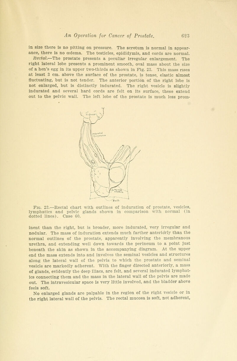 in size there is no pitting on pressure. The scrotum is normal in appear- ance, there is no cedema. The testicles, epididymis, and cords are normal. Rectal.—The prostate presents a peculiar irregular enlargement. The right lateral lobe presents a prominent smooth, oval mass about the size of a hen's egg in its upper two-thirds as shown in Fig. 23. This mass rises at least 3 cm. above the surface of the prostate, is tense, elastic almost fluctuating, but is not tender. The anterior portion of the right lobe is not enlarged, but is distinctly indurated. The right vesicle is slightly indurated and several hard cords are felt on its surface, these extend out to the pelvic wall. The left lobe of the prostate is much less prom- FiG. 23.—Rectal chart with outlines of induration of prostate, vesicles, lymphatics and pelvic glands shown in comparison with normal (in dotted lines). Case 60. inent than the right, but is broader, more indurated, very irregular and nodular. The mass of induration extends much farther anteriorly than the normal outlines of the prostate, apparently involving the membranous urethra, and extending well down towards the perineum to a point just beneath the skin as shown in the accompanying diagram. At the upper end the mass extends into and involves the seminal vesicles and structures along the lateral wall of the pelvis to which the prostate and seminal vesicle are markedly adherent. With the finger directed anteriorly, a mass of glands, evidently the deep iliacs, are felt, and several indurated lymphat- ics connecting them and the mass in the lateral wall of the pelvis are made out. The intravesicular space is very little involved, and the bladder above feels soft. No enlarged glands are palpable in the region of the right vesicle or in the right lateral wall of the pelvis. The rectal mucosa is soft, not adherent.