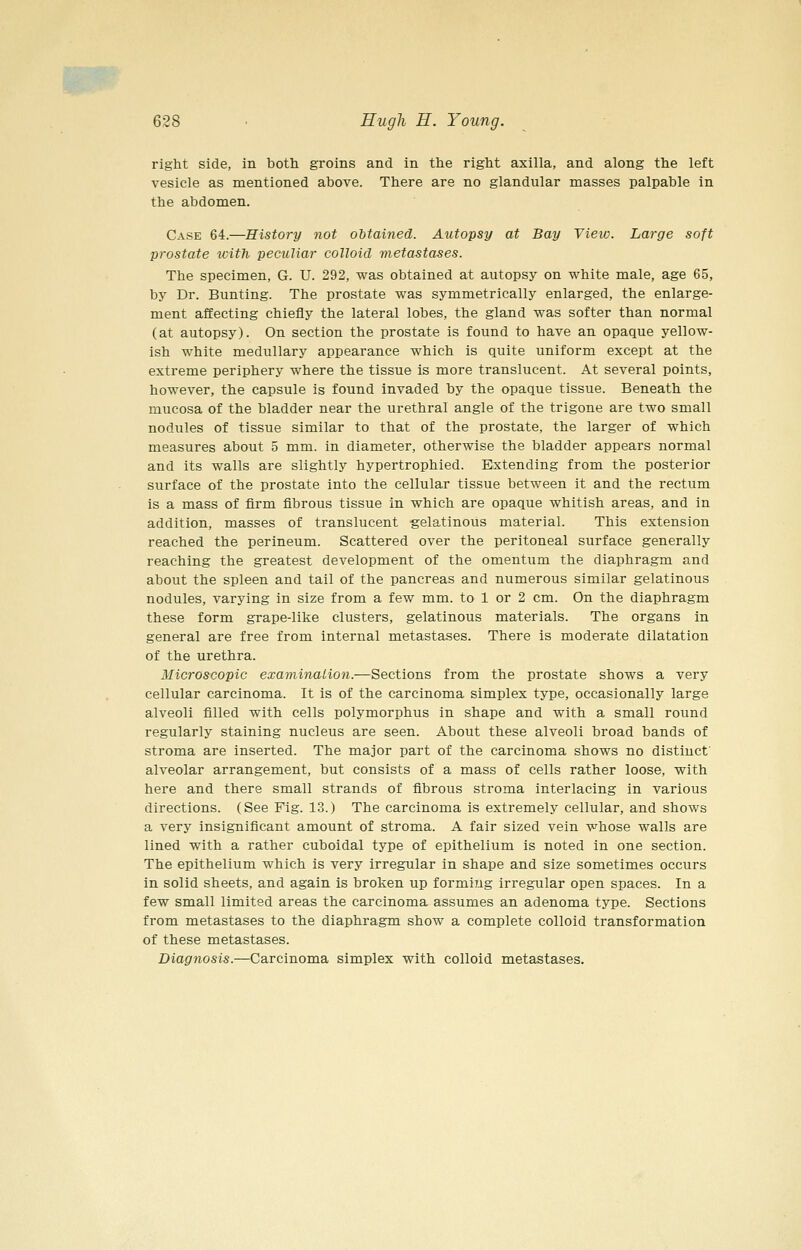 right side, in botli groins and in the right axilla, and along the left vesicle as mentioned above. There are no glandular masses palpable in the abdomen. Case 64.—History not obtained. Autopsy at Bay View. Large soft prostate with peculiar colloid metastases. The specimen, G. U. 292, was obtained at autopsy on white male, age 65, by Dr. Bunting. The prostate was symmetrically enlarged, the enlarge- ment affecting chiefly the lateral lobes, the gland was softer than normal (at autopsy). On section the prostate is found to have an opaque yellow- ish white medullary appearance which is quite uniform except at the extreme periphery where the tissue is more translucent. At several points, however, the capsule is found invaded by the opaque tissue. Beneath the mucosa of the bladder near the urethral angle of the trigone are two small nodules of tissue similar to that of the prostate, the larger of which measures about 5 mm. in diameter, otherwise the bladder appears normal and its walls are slightly hypertrophied. Extending from the posterior surface of the prostate into the cellular tissue between it and the rectum is a mass of firm fibrous tissue in which are opaque whitish areas, and in addition, masses of translucent gelatinous material. This extension reached the perineum. Scattered over the peritoneal surface generally reaching the greatest development of the omentum the diaphragm and about the spleen and tail of the pancreas and numerous similar gelatinous nodules, varying in size from a few mm. to 1 or 2 cm. On the diaphragm these form grape-like clusters, gelatinous materials. The organs in general are free from internal metastases. There is moderate dilatation of the urethra. Microscopic examinaiion.—Sections from the prostate shows a very cellular carcinoma. It is of the carcinoma simplex type, occasionally large alveoli filled with cells polymorphus in shape and with a small round regularly staining nucleus are seen. About these alveoli broad bands of stroma are inserted. The major part of the carcinoma shows no distinct' alveolar arrangement, but consists of a mass of cells rather loose, with here and there small strands of fibrous stroma interlacing in various directions. (See Fig. 13.) The carcinoma is extremely cellular, and shows a very insignificant amount of stroma. A fair sized vein whose walls are lined with a rather cuboidal type of epithelium is noted in one section. The epithelium which is very irregular in shape and size sometimes occurs in solid sheets, and again is broken up forming irregular open spaces. In a few small limited areas the carcinoma assumes an adenoma type. Sections from metastases to the diaphragm show a complete colloid transformation of these metastases. Diagnosis.—Carcinoma simplex with colloid metastases.