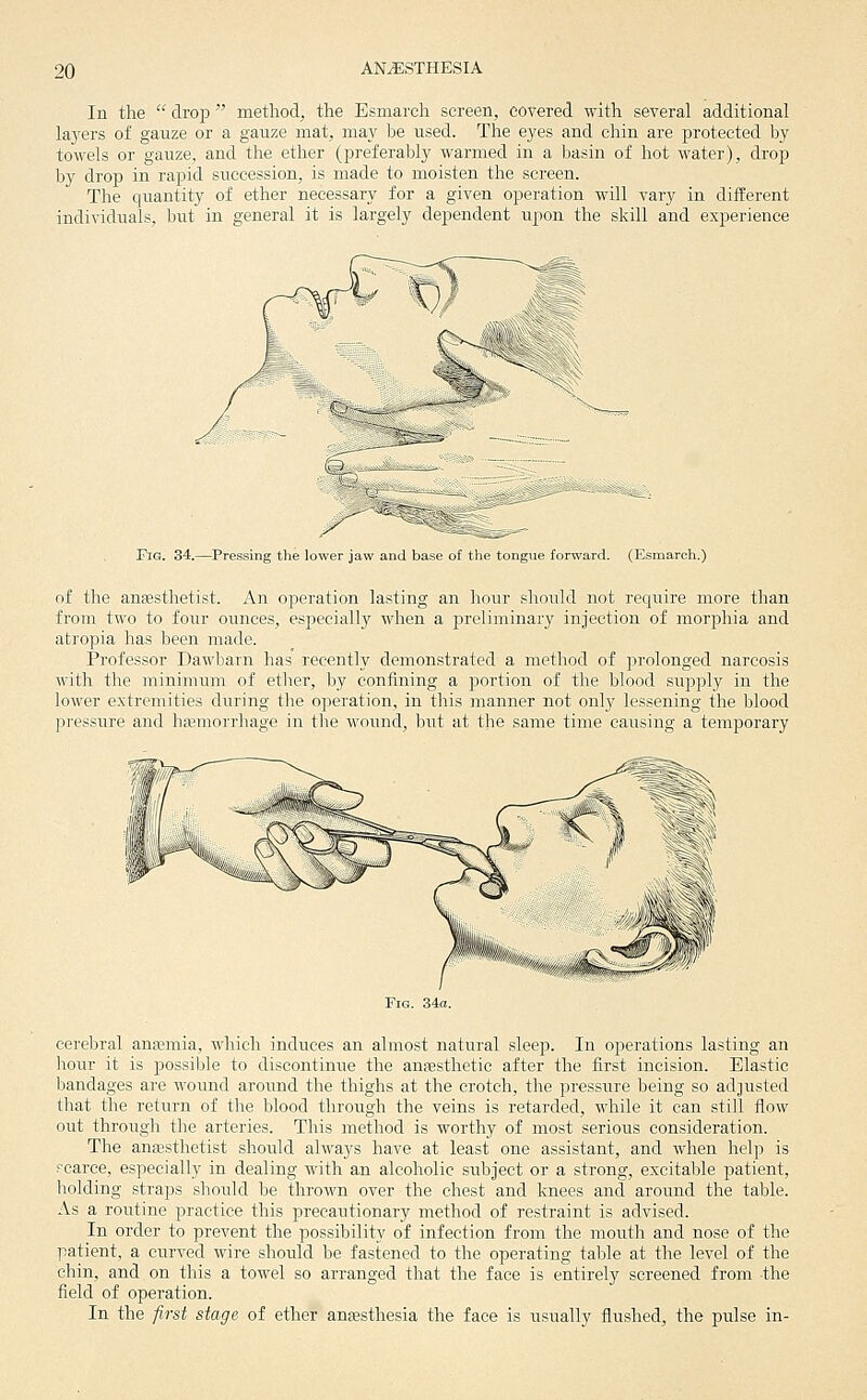 In the  drop  method, the Esmareh screen, covered with several additional la3'ers of gauze or a gauze mat, may be used. The eyes and chin are protected by towels or gauze, and the ether (preferably warmed in a basin of hot water), drop by droT) in rapid succession, is made to moisten the screen. The quantity of ether necessary for a given operation will vary in different individuals, but in general it is largely dependent upon the skill and experience Fig. 34.—Pressing the lower jaw and base of the tongue forward. (Esmareh.) of the anjesthetist. An operation lasting an hour should not require more than from two to four ounces, especially when a preliminary injection of morphia and atropia has been made. Professor Dawbarn has recently demonstrated a method of prolonged narcosis with the minimum of ether, by confining a portion of the blood supply in the lower extremities during the operation, in this manner not only lessening the blood pressure and hasmorrhage in the wound, but at the same time causing a temporary cerebral anaemia, which induces an almost natural sleep. In operations lasting an hour it is possible to discontinue the an;Esthetic after the first incision. Elastic bandages are wound around the thighs at the crotch, the pressure being so adjusted that the return of the blood through the veins is retarded, while it can still flow out through the arteries. This method is worthy of most serious consideration. The anajsthetist should always have at least one assistant, and when help is scarce, especially in dealing with an alcoholic subject or a strong, excitable patient, holding straps should be thrown over the chest and knees and around the table. As a routine practice this precautionary method of restraint is advised. In order to prevent the possibility of infection from the mouth and nose of the patient, a curved wire should be fastened to the operating table at the level of the chin, and on this a towel so arranged that the face is entirely screened from the field of operation. In the -first stage, of ether anaesthesia the face is usually flushed, the pulse in-