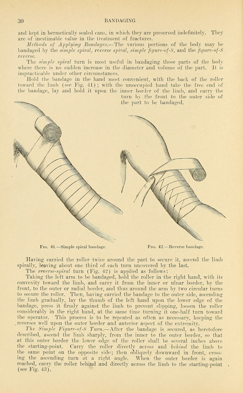 and kept in hermetically sealed cans, in which they are preserved indefinitely. They are of inestimable value in the treatment of fractures. Methods of Applying Bandages.—The various portions of the body may be bandaged by the simple spiral^ reverse spiral, simple figure-of-S, and the figure-of-8 reverse. . The simple spiral turn is most useful in bandaging those parts of the body where there is no sudden increase in the diameter and volume of the part. It is impracticable under other circumstances. Hold the bandage in the hand most convenient, with the back of the roller toward the limb (see Fig. 41); with the imoceupied hand take the free end of the bandage, lay and hold it upon the inner border of the limb, and carry the turn by the front to the outer side of the 2)art to he bandaged. Fig. 41.—Simple spiral bandage. FiG: 42.—Reverse bandage. Having carried the roller twice around the part to secure it, ascend the limb spirally, leaving about one third of each turn uncovered by the last. The reverse-spiral turn (Fig. 42) is applied as follows: Taking the left arm to be bandaged, hold the roller in the right hand, with its convexity toward the limb, and carry it from the inner or ulnar border, by the front, to the outer or radial border, and thus around the arm by two circular turns to secure the roller. Then, having carried the bandage to the outer side, ascending the limb gradually, lay the thumb of the left hand upion the lower edge of the bandage, press it firmly against the limb to prevent slipping, loosen the roller considerably in the right hand, at the same time turning it one-half turn toward the operator. This process is to be repeated as often as necessary, keeping the .reverses well upon the outer border and anterior aspect of the extremity. The Simple Figure-of-S Turn.—After the bandage is secured, as heretofore described, ascend the limb sharply, from the inner to the outer border, so that at this outer border the lower edge of the roller shall be se^•eral inches above the starting-point. Carry the roller dircctlv across and iehind the limb to the same point on the opposite side; then oljliquely do^vnward in front, cross- ing the ascending turn at a riglit angle. When the outer border is again reached, carry the roller behind and directly across the limb to the starting-point (see Fig. 43).