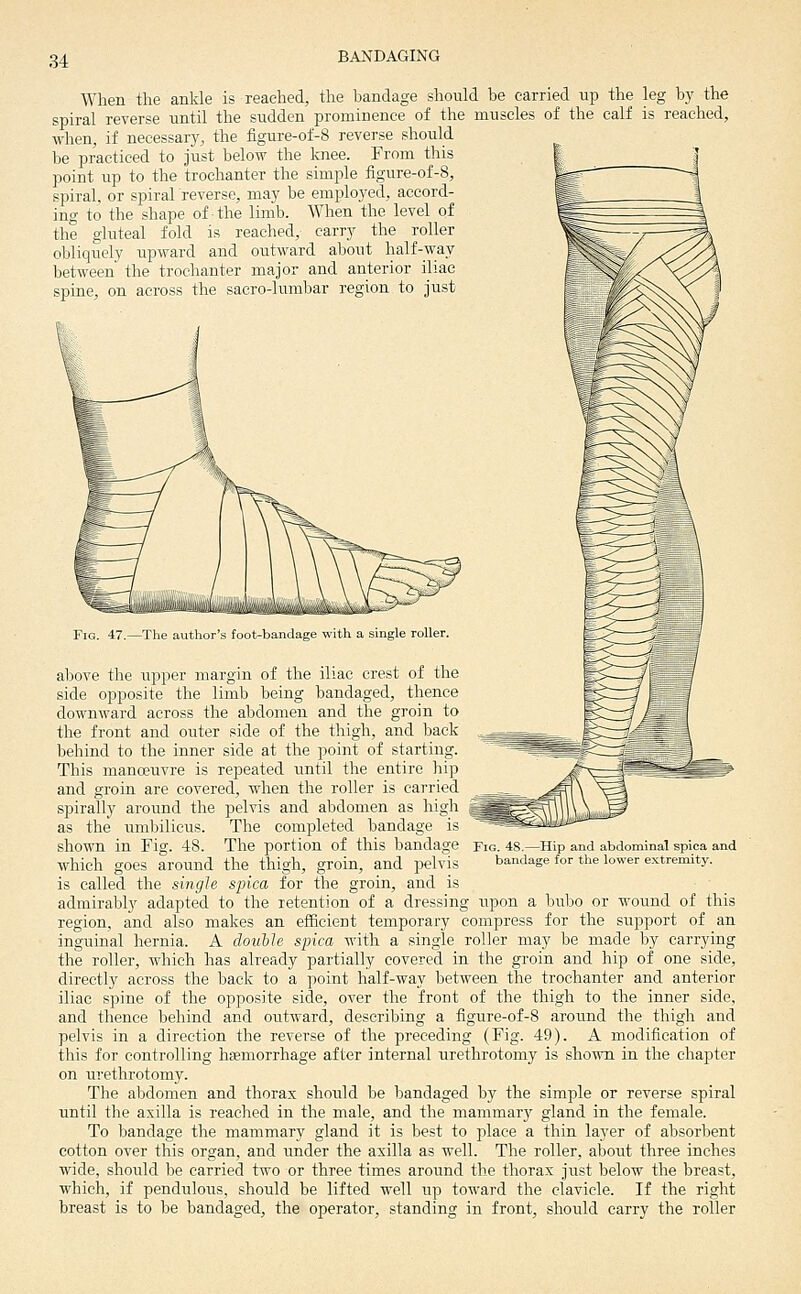 When the ankle is reached, the bandage should be carried up the leg by the spiral reverse until the sudden pronainence of the muscles of the calf is reached, when, if necessary, the figure-of-8 reverse should be practiced to just below the knee. From this point up to the trochanter the simple figure-of-8, spiral, or spiral reverse, may be employed, accord- ing to the shape of the limb. When the level of the gluteal fold is reached, carry the roller obliquely upward and outward about half-way between the trochanter major and anterior iliac spine, on across the sacro-lumbar region to just Fig. 47.—Tlie author's foot-bandage with a single roller. above the upper margin of the iliac crest of the side opposite the limb being bandaged, thence downward across the abdomen and the groin to the front and outer side of the thigh, and back behind to the inner side at the point of starting. This mancKUvre is repeated until the entire hip and groin are covered, when the roller is carried ^^^^^^_ spirally around the pelvis and abdomen as high %'~~ as the umbilicus. The completed bandage is shown in Fig. 48. The portion of this bandage Y\g. 48.—Hip and abdominal spica and which goes around the thigh, groin, and pelvis bandage for the lower extremity. is called the single spica for the groin, and is admirably adapted to the retention of a dressing upon a bubo or wound of this region, and also makes an efficient temporary compress for the support of an inguinal hernia. A double spica with a single roller may be made by carrying the roller, which has already partially covered in the groin and hip of one side, directly across the back to a point half-way between the trochanter and anterior iliac spine of the opposite side, over the front of the thigh to the inner side, and thence behind and outward, describing a figure-of-8 around the thigh and pelvis in a direction the reverse of the preceding (Fig. 49). A modification of this for controlling haemorrhage after internal urethrotomy is shown in the chapter on urethrotomy. The aljdomen and thorax should be bandaged by the simple or reverse spiral until the axilla is reached in the male, and the mammary gland in the female. To bandage the mammary gland it is best to place a thin layer of absorbent cotton over this organ, and under the axilla as well. The roller, about three inches wide, should be carried two or three times around the thorax just below the breast, which, if pendulous, should be lifted well up toward the clavicle. If the right breast is to be bandaged, the operator, standing in front, should carry the roller