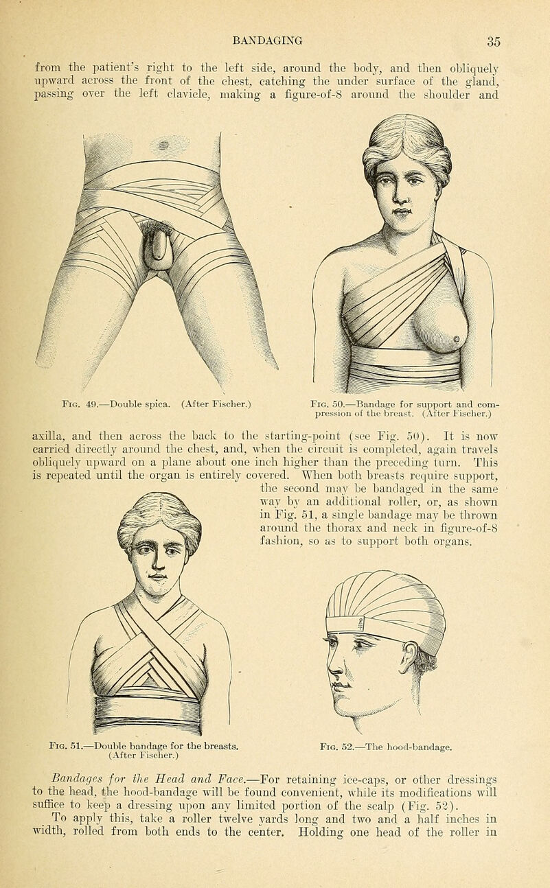 from the patient's right to the left side, around the body, and then obliquely upward across the front of the chest, catching the under surface of the gland, passing over the left clavicle, making a figure-of-S around the shoulder and Fig. 49.—Double spica. (After Fischer.) Fig. 50.—Bandage for support and com- pression of the brea.st. (After Fischer.) axilla, and then across the back to the starting-point (see Fig. 50). It is now carried directly around the chest, and, when the circuit is completed, again travels obliquely itpward on a plane about one inch higher than the preceding turn. This is repeated until the organ is entirely covered. When both breasts require support, the second may be bandaged in the same way by an additional roller, or, as shown in Fig. 51, a single bandage may be thrown around the thorax and neck in figure-of-8 fashion, so as to support both organs. Fig. 51.—Double bandage for the breasts. (After Fischer.) Fig. 52.—The hood-bandage. Bandages for the Head and Face.—For retaining ice-caps, or other dressings to the head, the hood-bandage will be found convenient, while its modifications will sufBce to keep a dressing upon any limited portion of the scalp (Fig. 52). To apply this, take a roller twelve yards long and two and a half inches in width, rolled from both ends to the center. Holding one head of the roller in
