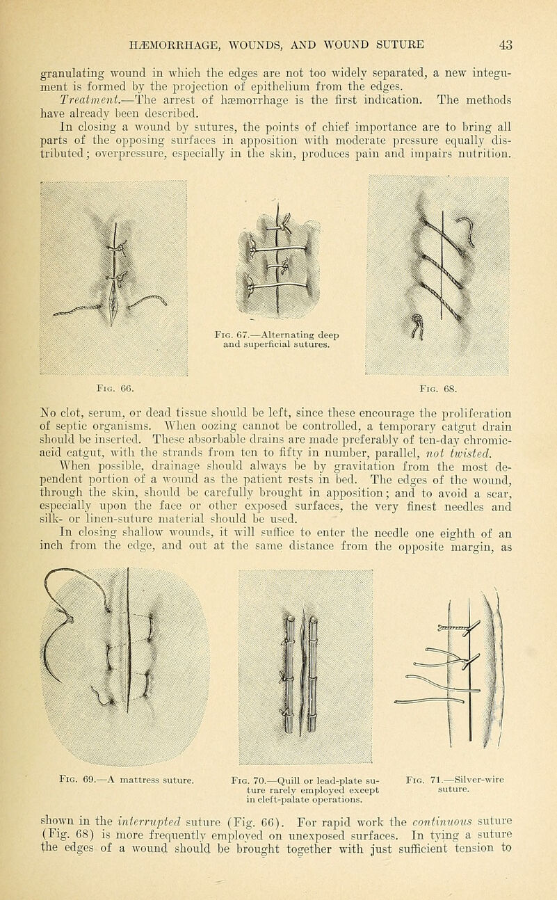 granulating wound in which the edges are not too widely separated, a new integu- ment is formed by the projection of epithelium from the edges. Treatment.—The arrest of hemorrhage is the first indication. The methods have already been described. In closing a wound by sutures, the points of chief importance are to bring all parts of the opposing surfaces in apposition with moderate pressure equally dis- tributed; overpressure, especially in the skin, produces pain and impairs nutrition. :4 W 1 i-f^- Fig. 67.—Alternating deep and superficial sutures. No clot, serum, or dead tissue should be left, since these encourage the proliferation of septic organisms. AVhen oozing cannot be controlled, a temporary catgut drain should be inserted. These absorbable drains are made preferably of ten-day chromic- aeid catgut, with the strands from ten to fifty in number, parallel, not tivisted. When possible, drainage should always be by gravitation from the most de- pendent portion of a wound as the patient rests in bed. The edges of the wound, through the skin, should be carefully brought in apposition; and to avoid a scar, especially upon the face or other exposed surfaces, the very finest needles and silk- or linen-suture material should be used. In closing shallow wounds, it will suffice to enter the needle one eighth of an inch from tlie ed-o. and out at the same distaneo from the opposite margin, as ^ '^^ I Fig. 69.—A mattress suture. Fig 70 —Quill or lead-plate su- ture rarely employed except in cleft-palate operations. Fig. 71.—Silve suture. shown in the interrupted suture (Fig. 66). For rapid work the continuous suture (Fig. 68) is more frequently employed on unexposed surfaces. In tying a suture the edges of a wound should be brought together with Just sufficient tension to