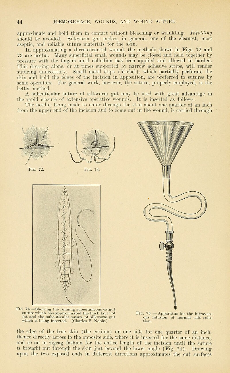 approximate and hold them in contact without bleaching or wrinkling. Infolding should be avoided. Silkworjn gut makes, in general, one of the cleanest, most aseptic, and reliable suture materials for the skin. In approximating a tliree-cornered wound, the methods shown in Figs. 73 and 73 are useful. Many superficial small wounds may be closed and held together by pressure with the fingers until collodion has been applied and allowed to harden. This dressing alone, or at times supjjorted by narrow adhesive strips, will render suturing vmnecessaiy. Small metal clips (Michel), which partially perforate the skin and hold the edges of the incision in apposition, are j^referred to sutures by some operators. For general work, however, the suture, properly employed, is the better method. A subcuticular suture of silkworm gut may be used with great advantage in the rapid closure of extensive operative wounds. It is inserted as follows: The needle, being made to enter through the skin about one quarter of an inch from the ujjper end of the incision and to come out in the wound, is carried through Fig. 74.—Showing the ranning subcutaneous catgut suture which has approxiniated the tliiclv layer of fat and tlie subcuticular suture of silkworm gut which is being inserted. (Charles P. Noble.) Fig. 75.;— Apparatus for the intraven- ous infusion of normal salt solu- tion. the edge of the true skin (the eorium) on one side for one quarter of an inch, thence directly across to the opposite side, where it is inserted for the same distance, and so on in zigzag fashion for the entire length of the incision until the suture is brought out through the skin just beyond the lower angle (Fig. 74). Drawing upon the two exposed ends in different directions approximates the cut surfaces