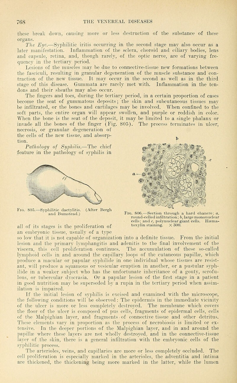 these break down, causing more or less destruction of the substance of these organs. The Eye.—Syphilitic iritis occurring in the second stage may also occur as a later manifestation. Inflammation of the sclera, choroid and ciliary bodies, lens and capsule, retina, and, though rarely, of the optic nerve, are of varying fre- quency in the tertiary period. Lesions of the muscles may be due to connective-tissue new formations between the fasciculi, resulting in granular degeneration of the muscle substance and con- traction of the new tissue. It may occur in the second as well as in the third stage of this disease. Gummata are rarely met with. Inflammation in the ten- dons and their sheaths may also occur. The fingers and toes, during the tertiary period, in a certain proportion of cases become the seat of gummatous deposits; the skin and subcutaneous tissues may be infiltrated, or the bones and cartilages may be involved. When confined to the soft parts, the entire organ will appear swollen, and purple or reddish in color. When the bone is the seat of the deposit, it may be limited to a single phalanx or invade all the bones of the finger (Fig. 805). The process terminates in ulcer, necrosis, or granular degeneration of the cells of the new tissue, and absorp- tion. Pathology of Syphilis.—The chief g^Sfif® '#!!'© I^^ feature in the pathology of sj-philis in ■ - - .^6 ^^~ ^^&->r- -Syphilitic dactylitis, and Bxunstead.) (After Bergh Fig. S06.—Section through a hard chancre: a, round-celled infiltration; h, large mononuclear cells: and c, polynuciear giant cells. HEema- toxylin staining. X 300. all of its stages is the proliferation of an embryonic tissue, usually of a type so low that it is not capable of organization into a definite tissue. From the initial lesion and the primary lymphangitis and adenitis to the final involvement of the viscera, this cell proliferation continues. The accumulation of these so-called lymphoid cells in and around the capillary loops of the cutaneous papillse, which produce a macular or papular syphilide in one individual whose tissues are resist- ant, will produce a squamous or vesicular eruption in another, or a pustular S5'ph- ilide in a weal^ier subject who has the unfortunate inheritance of a gouty, scrofu- lous, or tubercular dyscrasia. Or a papular lesion of the first stage in a patient in good nutrition may be suj^erseded by a rupia in the tertiary j)eriod when assim- ilation is impaired. If the initial lesion of syphilis is excised and examined with the microscope, the following conditions will be observed: The epidermis in the immediate vicinity of the ulcer is more or less completely destroyed. The membrane which covers the floor of the ulcer is composed of pus cells, fragments of epidermal cells, cells of the Malpighian layer, and fragments of connective tissue and other detritus. These elements vary in proportion as the process of necrobiosis is limited or ex- tensive. In the deeper portions of the Malpighian layer, and in and around the papillse where these layers are not wholly destroyed, and in the connective-tissue layer of the skin, there is a general infiltration with the embryonic cells of the syiDhilitic process. The arterioles, veins, and capillaries are more or less completely occluded. The cell proliferation is especially marked in the arterioles, the adventitia and intima are thickened, the thickening being more marked in the latter, while the lumen
