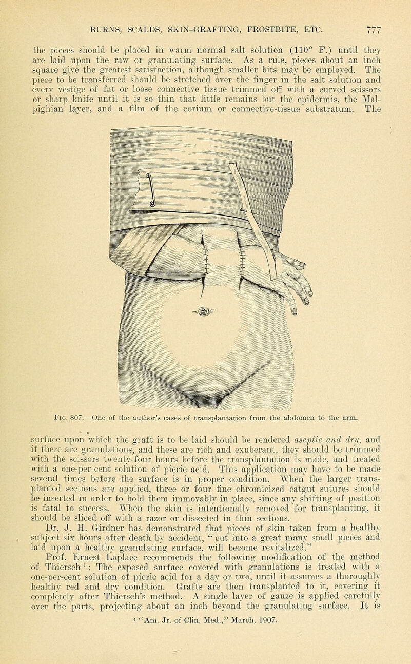 the pieces should be placed in warm normal salt solution (110° P.) until they are laid upon the raw or granulating surface. As a rule, pieces about an inch square give the greatest satisfaction, although smaller bits may be employed. The piece to be transferred should be stretched over the finger in the salt solution and every vestige of fat or loose connective tissue trimmed off with a curved scissors or sharp knife until it is so thin that little remains but the epidermis, the Mal- pighian layer, and a film of the corium or connective-tissue substratum. The Fig. 807.—One of th( :j[ tr;iiispluntatioii fniiu the abdomen to the surface upon which the graft is to be laid should be rendered aseptic and dry, and if there are granulations, and these are rich and exuberant, they should be trimmed with the scissors twenty-four hours before the transplantation is made, and treated with a one-per-cent solution of picric acid. This application may have to be made several times before the surface is in proper condition. When the larger trans- planted sections are applied, three or four fine chromicized catgut sutures should be inserted in order to hold them immovably in place, since any shifting of position is fatal to success. When the skin is intentionally removed for transplanting, it should be sliced off with a razor or dissected in thin sections. Dr. J. H. Girdner has demonstrated that pieces of skin taken from a healthy subject six hours after death by accident, cut into a great many small pieces and laid upon a healthy granulating surface, will become revitalized. Prof. Ernest Laplace recommends the following modification of the method of Thiersch ^: The exposed surface covered with granulations is treated with a one-per-cent solution of picric acid for a day or two, until it assumes a thoroughly healthy red and dry condition. Grafts are then transplanted to it, covering it completely after Thiersch's method. A single layer of gauze is applied carefully over the parts, projecting about an inch beyond the granulating surface. It is 1 Am. Jr. of Clin. Med., March, 1907.