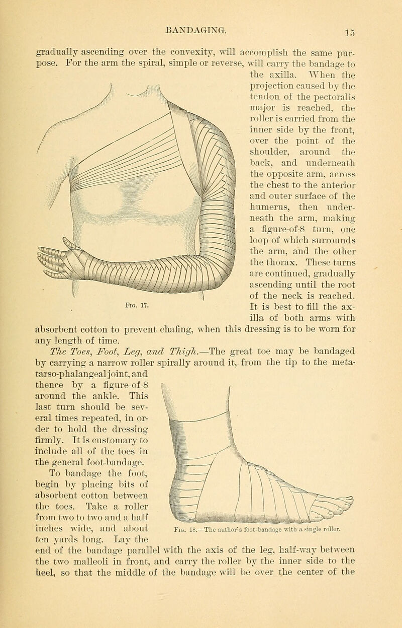 gi-aduaUy ascending over the convexity, will accomplish the same pur- pose. For the arm the spiral, simple or reverse, will carry the bandage to the axilla. When the projection caused by the tendon of the pectoralis major is reached, the roller is carried from the inner side by the front, over the point of the shoulder, around the back, and underneath the opposite arm, across the chest to the anterior and outer surface of the liumerus, then under- neath the arm, making a fignre-of-8 turn, one loop of which surrounds the arm, and the other the thorax. These turns are continued, gradually ascending until the root of the neck is reached. ^»- 1^- It is best to fill the ax- illa of both arms with absorbent cotton to prevent chafing, when this di'essing is to be worn for any length of time. Tlie Toes, Foot, Leg, and Thigh.—The great toe may be bandaged by carrying a narrow roller spirally around it, fi'om the tijp to the meta- tarso-phalangeal joint, and thence by a figure-of-8 around the ankle. This last turn should be sev- eral times repeated, in or- der to hold the dressing firmly. It is ciistomary to include all of the toes in the general foot-bandage. To bandage the foot, begin by jjlacing bits of absorbent cotton between the toes. Take a roller from two to two and a half inches wide, and about ten yards long. Lay the end of the bandage parallel with the axis of the leg, half-way between the two malleoli in front, and carry the roller by the inner side to the heel, so that the middle of the bandage will be over the center of the Fig. is.—The author's foot-bandaire svith a single roller.