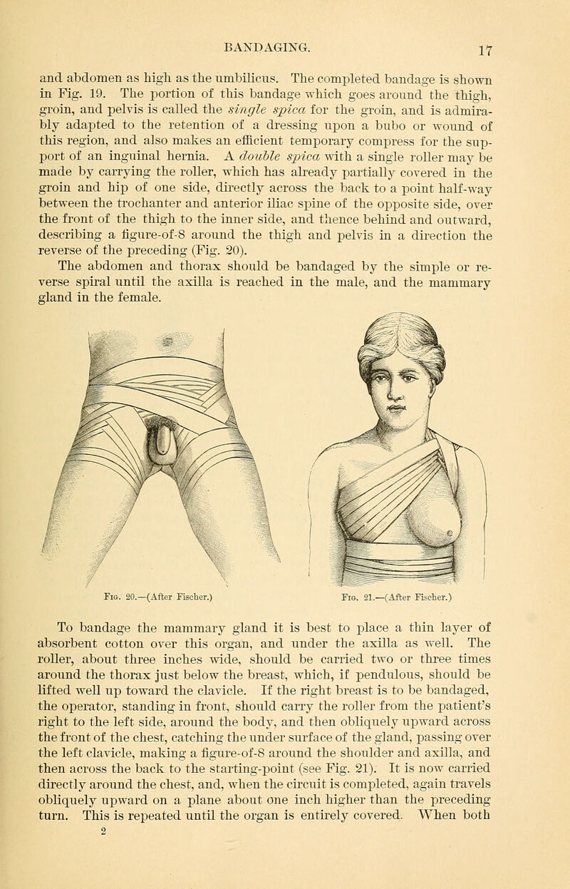 and abdomen as Mgli as the Timbilicns. The completed bandage is shown in Fig. 19. The portion of this bandage which goes around the thigh, groin, and pelvis is called the single spica for the groin, and is admira- bly adapted to the retention of a dressing upon a bubo or wound of this region, and also makes an efficient temporary compress for the sup- port of an inguinal hernia. A double spica with a single roller may be made by carrying the roller, which has ah-eady partially covered in the groin and hip of one side, directly across the back to a point half-way between the trochanter and anterior iliac spine of the opposite side, over the front of the thigh to the inner side, and tlience behind and outward, describing a ligure-of-8 around the thigh and pelvis in a direction the reverse of the preceding (Fig. 20). The abdomen and thorax should be bandaged by the simple or re- verse spiral until the axilla is reached in the male, and the mammary gland in the female. Fig. 20.—(After Fiscter.) To bandage the mammary gland it is best to ]olace a thin layer of absorbent cotton over this organ, and under the axilla as well. The roller, about three inches wide, should be carried two or thi-ee times around the thorax just below the breast, which, if pendiilous, should be lifted well up toward the clavicle. If the right breast is to be bandaged, the operator, standing in front, should caiTy the roller from the patient's right to the left side, around the body, and then obliquely u^Dward across the front of the chest, catching the under surface of the gland, passing over the left clavicle, making a figure-of-8 around the shoulder and axilla, and then across the back to the starting-point (see Fig. 21). It is now carried directly around the chest, and, when the circuit is completed, again travels obliquely upward on a plane about one inch higher than the preceding turn. This is repeated until the organ is entirely covered. When both 2