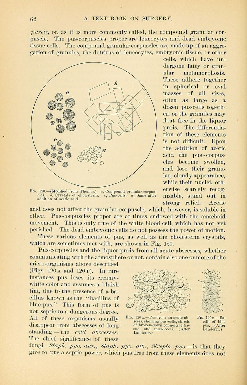 puscle, or, as it is more commonly called, the compound granular cor- puscle. The pus-corpuscles proper are leucocytes and dead embryonic tissue-cells. The compound granular corpuscles are made up of an aggre- gation of granules, the detritus of leucocytes, embi'yonic tissue, or other cells, which have un- dergone fatty or gran- ular metamorphosis. These adhere together in spherical or oval masses of all sizes, often as large as a dozen pus-cells togeth- er, or the granules may float free in the liquor puris. The differentia- tion of these elements is not difficult. Upon the addition of acetic acid the jaus - corpus- cles become swollen, and lose their granu- lar, cloudy appearance, while their nuclei, oth- erwise scarcely recog- nizable, stand out in strong relief. Acetic acid does not affect the gramdar corpuscle, which, however, is soluble in ether. Pus-corpuscles jjroper are at times endowed with the amoeboid movement. This is only true of the white blood-cell, which has not yet perished. The dead embryonic cells do not possess the power of motion. These various elements of pus, as well as the cholesterin crystals, which are sometimes met with, are shown in Fig. 120. Pus-corpuscles and the liquor puris from all acute abscesses, whether communicating with the atmosphere or not, contain also one or more of the micro-organisms above described (Pigs. 120 a and 120 b). In rare instances pus loses its creamy- white color and assumes a bluish tint, due to the presence of a ba- cillus known as the bacillus of blue pus. This form of pus is not septic to a dangerous degree. All of these organisms usually disappear from abscesses of long standing — the cold abscesses. The chief significance of these tm\g\—Staph, pyo. aur., Staph, pyo. alb., Strepto. pyo.—is that they give to pus a septic power, which pus free from these elements does not Fig. 120.—(Modified from Thomas.) a, Compound granular corpus- cles. I), Crystals of cholesterin. c, Pus-ceils, d, Same after addition of acetic acid. cP^o^ o^ =-^ ^' FiQ 120 A —Pus fiom an leute ab seesi, showint; pus cells, shreds of broken down connective tis- sue, and micrococci. (After Landerer.) Pig 120 b—Bi- ciUi ot blue £us (Alter andcrer.)