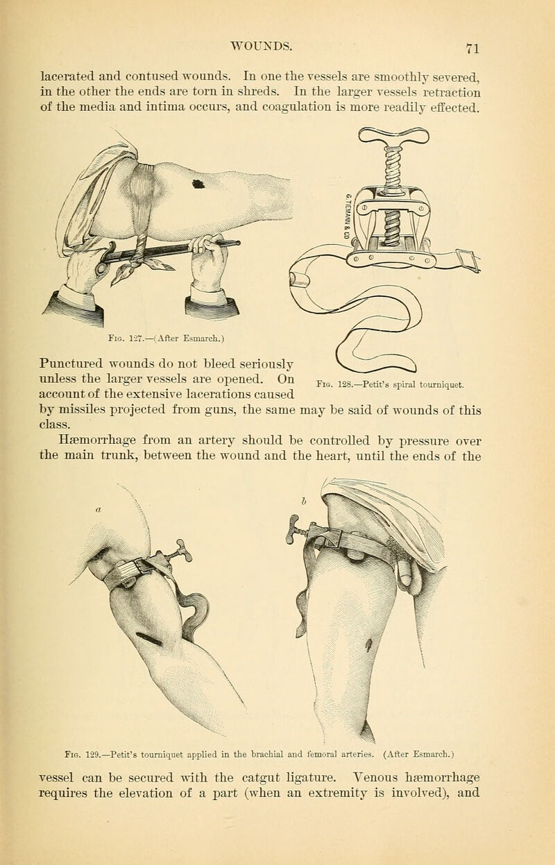 lacerated and contused wounds. In one the vessels are smoothly severed, in the other the ends are torn in shreds. In the larger vessels retraction of the media and intima occui's, and coagulation is more readily effected. Fig. 127.—(After Esmarch.) Punctured wounds do not bleed seriously unless the larger vessels are opened. On j.,^. las.I^etit's spiral tourniquet. account of the extensive lacerations caused by missUes projected fi-om guns, the same may be said of woimds of this class. Haemorrhage from an artery should be controlled by pressure over the main trunk, between the wound and the heart, until the ends of the Fig. 129.—^Petit's tourniquet applied in the brachial and femoral arteries. (After Esmarch.) vessel can be secured with the catgut ligature. Venous hsemorrhage requires the elevation of a part (when an extremity is involved), and