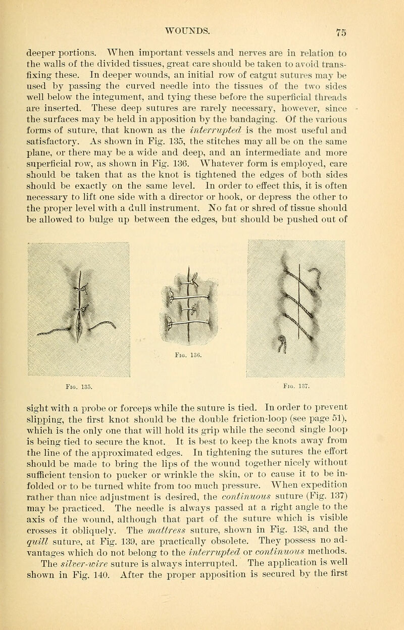 deeper portions. When imjDortant vessels and nerves are in relation to the walls of the divided tissues, great care should be taken to avoid trans- fixing these. In deeper wounds, an initial row of catgut sutures may be used by passing the curved needle into the tissues of the two sides well below the integument, and tying these before the superficial threads are inserted. These deep sutures are rarely necessary, however, since the surfaces may be held in apposition by the bandaging. Of the various forms of suture, that known as the interrupted is the most useful and satisfactory. As shown in Fig. 135, the stitches may all be on the same plane, or there may be a wide and deep, and an intermediate and more superficial row, as shown in Fig. 136. Whatever form is employed, care should be taken that as the knot is tightened the edges of both sides should be exactly on the same level. In order to effect this, it is often necessary to lift one side with a dkector or hook, or depress the other to the proper level with a dull instrument. No fat or shred of tissue should be allowed to bulge up between the edges, but should be pushed out of K \ sight with a probe or forceps while the suture is tied. In order to prevent slipping, the first knot should be the double friction-loop (see page 51), which is the only one that will hold its grip while the second single loop is being tied to secure the knot. It is best to keep the knots away from the line of the approximated edges. In tightening the sutures the efl'ort should be made to bring the lips of the wound together nicely without sufficient tension to pucker or v\Tinkle the skin, or to cause it to be in- folded or to be turned white from too much pressure. When expedition rather than nice adjustment is desired, the continuous suture (Fig. 137) may be practiced. The needle is always passed at a right angle to the axis of the wound, although that part of the suture which is visible crosses it obliquely. The mattress suture, shown in Fig. 138, and the quitl suture, at Fig. 139, are practically obsolete. They possess no ad- vantages which do not belong to the interrupted or continuous methods. The silver-wire suture is always interrupted. The application is well shown in Fig. 140. After the proper apposition is secured by the first