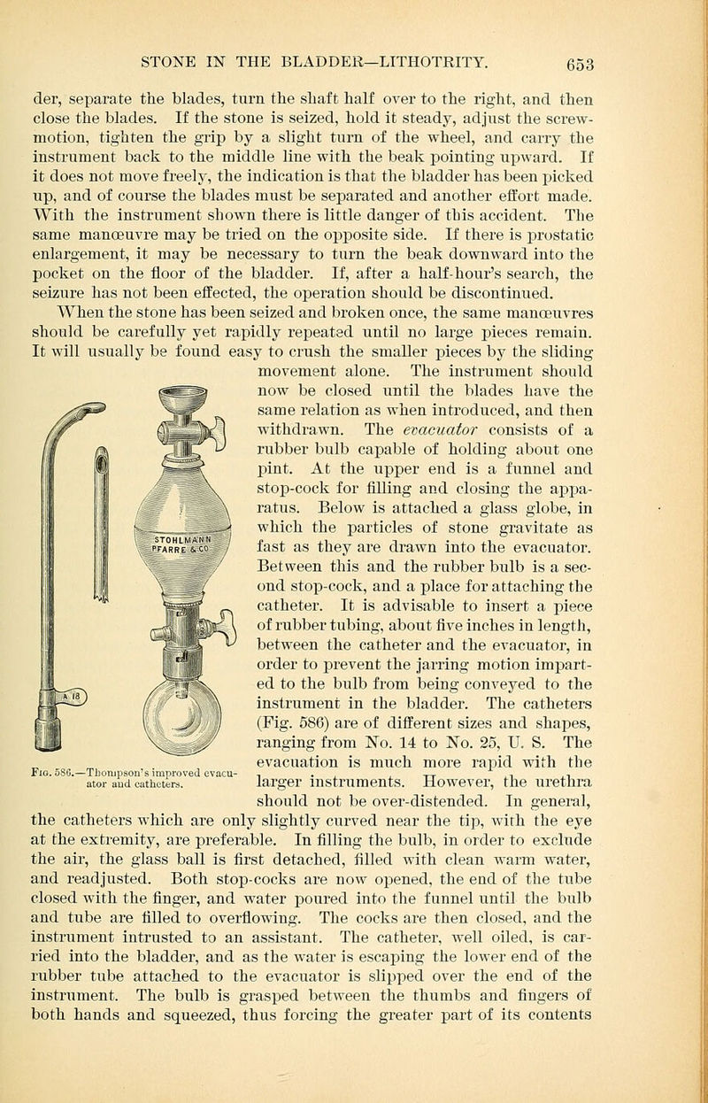 der, separate the blades, turn the shaft half over to the right, and then close the blades. If the stone is seized, hold it steady, adjust the screw- motion, tighten the grip by a slight turn of the wheel, and carry the instrument back to the middle line with the beak pointing upward. If it does not move freely, the indication is that the bladder has been picked up, and of course the blades must be separated and another effort made. With the instrument shown there is little danger of this accident. The same manoeuvre may be tried on the opposite side. If there is prostatic enlargement, it may be necessary to turn the beak downward into the pocket on the floor of the bladder. If, after a half-hour's search, the seizure has not been effected, the operation should be discontinued. When the stone has been seized and broken once, the same manoeuvres should be carefully yet rapidly repeated until no large pieces remain. It will usually be found easy to crush the smaller pieces by the sliding movement alone. The instrument should now be closed until the blades have the same relation as when introduced, and then withdrawn. The evacuator consists of a rubber bulb capable of holding about one pint. At the upper end is a funnel and stop-cock for filling and closing the appa- ratus. Below is attached a glass globe, in which the particles of stone gravitate as fast as they are drawn into the evacuator. Between this and the rubber bulb is a sec- ond stop-cock, and a place for attaching the catheter. It is advisable to insert a piece of rubber tubing, about five inches in length, between the catheter and the evacuator, in order to prevent the jarring motion impart- ed to the bulb from being conveyed to the instrument in the bladder. The catheters (Fig. 586) are of different sizes and shapes, ranging from No. 14 to No. 25, U. S. The evacuation is much more rapid with the larger instruments. However, the urethra should not be over-distended. In general, the catheters which are only slightly curved near the tip, with the eye at the extremity, are preferable. In filling the bulb, in order to exclude the air, the glass ball is first detached, filled with clean warm water, and readjusted. Both stop-cocks are now opened, the end of the tube closed with the finger, and water poured into the funnel until the bulb and tube are filled to overflowing. The cocks are then closed, and the instrument intrusted to an assistant. The catheter, well oiled, is car- ried into the bladder, and as the water is escaping the lower end of the rubber tube attached to the evac^^ator is slipped over the end of the instrument. The bulb is grasped between the thumbs and fingers of both hands and squeezed, thus forcing the greater part of its contents Fio. 580.—Thompson's improved evacu- ator and catheters.