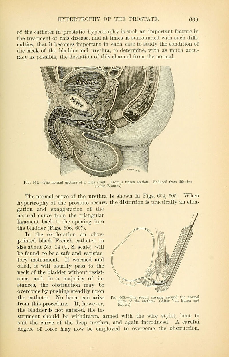 of the catheter in prostatic hypertrophy is such an important feature in the treatment of this disease, and at times is surrounded -nith such diffi- culties, that it becomes important in each case to study the condition of the neck of the bladder and urethra, to determine, with as much accu- racy as possible, the deviation of this channel from the nonnal. it. ^^ w.'*^ / ^ Fig. 604.—The normal urethra of a male adult. From a frozen section. Keduced from life size. (After Braune.) The normal curve of the urethra is shown in Figs. 604, 605. AYhen hypertrophy of the prostate occurs, the distortion is practically an elon- gation and exaggeration of the natural curve from the tiiangular ligament back to the opening into the bladder (Figs. 606, 607). In the exploration an olive- pointed black French catheter, in size aboiit No. 14 (U. S. scale), will be found to be a safe and satisfac- tory instrument. If warmed and oiled, it will usually pass to the neck of the bladder without resist- ance, and, in. a majority of in- stances, the obstruction may be overcome by pushing steadily upon the catheter. ]So hann can arise from this procedure. If, however, the bladder is not entered, the in- strument should be withdrawn, armed with the wii-e stylet, bent to suit the curve of the deep urethra, and again introduced. A careful degree of force inay now be employed to overcome the obstruction. Fig. 605.—The sound passing curve of the urethra. (A Keyes.) around the norma! ;er Van Buren and