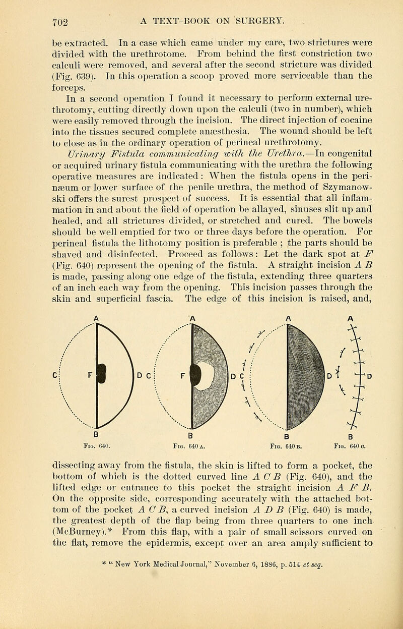 be extracted. In a case which came under my care, two strictures were divided with the urethrotome. From behind the first constriction two calculi were removed, and several after the second stricture was divided (Fig. 639). In this operation a scoop proved more serviceable than the forceps. In a second operation I found it necessary to perform external ure- throtomy, cutting directly down upon the calculi (two in number), which were easily removed through the incision. The direct injection of cocaine into the tissues secured complete aneesthesia. The wound should be left to close as in the ordinary operation of perineal urethrotomy. Urinary Fistula communicating toitit the Urethra.—In congenital or acquired urinary fistula communicating with the urethra the following operative measures are indicated: When the fistula opens in the peri- nseum or lower surface of the penile urethra, the method of Szymanow- ski offers the surest prospect of success. It is essential that all inflam- mation in and about the field of operation be allayed, sinuses slit up and healed, and all strictures divided, or stretched and cured. The bowels should be well emptied for two or three days before the operation. For perineal fistula the lithotomy position is preferable ; the parts should be shaved and disinfected. Proceed as follows: Let the dark spot at F (Fig. 640) represent the opening of the fistula. A straight incision A B is made, passing along one edge of the fistula, extending three quarters of an inch each way from the opening. This incision passes through the skin and superficial fascia. The edge of this incision is raised, and, D Ci dissecting away from the fistula, the skin is lifted to form a pocket, the bottom of which is the dotted curved line AGB (Fig. 640), and the lifted edge or entrance to this pocket the straight incision A F B. On the opposite side, corresponding accurately Math the attached bot- tom of the pocket A G B., •& curved incision A D B (Fig. 640) is made, the greatest depth of the flap being from three quarters to one inch (McBurney).* From this flap, with a pair of small scissors curved on the flat, remove the ei^idermis, except over an area amply sufficient to *  New York Medical Journal, November 6, 1886, p. 514 ct seq.