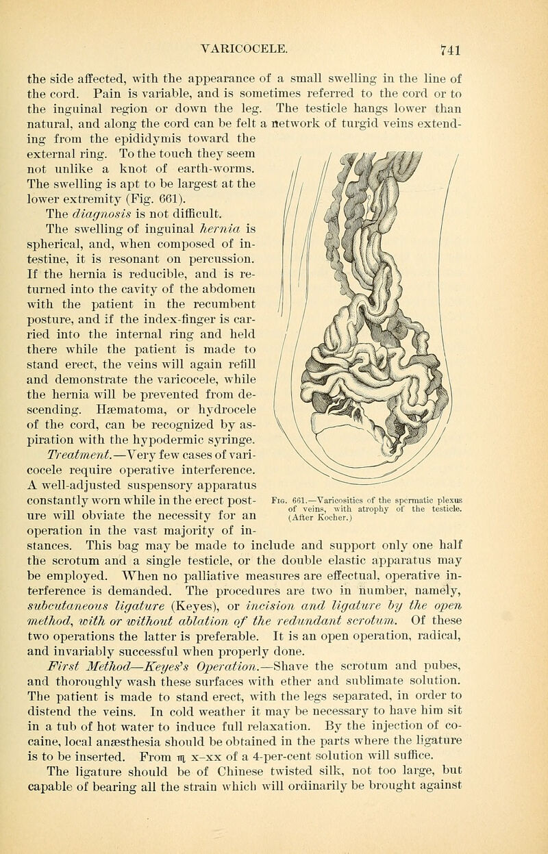 VARICOCELE. 14:1 the side affected, with the appearance of a small swelling in the line of the cord. Pain is variable, and is sometimes referred to the cord or to the inguinal region or down the leg. The testicle hangs lower than natural, and along the cord can be felt a network of turgid veins extend- ing from the epididymis toward the external ring. To the toiich they seem not unlike a knot of earth-worms. The swelling is apt to be largest at the lower extremity (Fig. 661). The diagnosis is not difScult. The swelling of inguinal hernia is spherical, and, when composed of in- testine, it is resonant on percussion. If the hernia is reducible, and is re- turned into the cavity of the abdomen with the patient in the recumbent posture, and if the index-finger is car- ried into the internal ring and held there while the patient is made to stand erect, the veins will again refill and demonstrate the varicocele, while the hernia will be prevented from de- scending. Hsematoma, or hydrocele of the cord, can be recognized by as- piration with the hypodermic syringe. Treatment.—Very few cases of vari- cocele require operative interference. A well-adjusted suspensory apparatus constantly worn while in the erect post- ure will obviate the necessity for an operation in the vast majority of in- stances. This bag may be made to include and support only one half the scrotum and a single testicle, or the double elastic apparatus may be employed. When no palliative measures are effectual, operative in- terference is demanded. The procedures are two in number, namely, subcutaneous ligature (Keyes), or incision and ligature hy the open method., with or without ablation of the redundant scrotum. Of these two operations the latter is preferable. It is an open operation, radical, and invariably successful when properly done. First Method—Reyes's Operation.—Shave the scrotum and pubes, and thoroughly wash these surfaces with ether and sublimate solution. The patient is made to stand erect, with the legs separated, in order to distend the veins. In cold weather it may be necessary to have him sit in a tub of hot water to induce full relaxation. By the injection of co- caine, local anfesthesia should be obtained in the parts where the ligature is to be inserted. From n x-xx of a 4-per-cent solution will suffice. The ligature should be of Chinese twisted silk, not too large, but capable of bearing all the strain whicli will ordinarily be brought against Fig. 661.—Varicosities of the spermatic plexus of veins, with atrophy of the testicle. (After Kocher.)