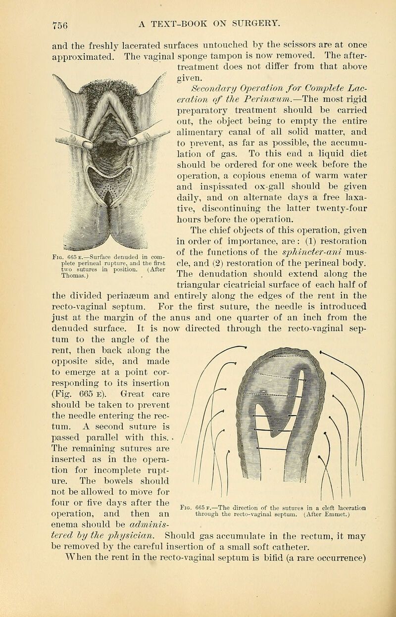 Fig. 665 e.—Surface denuded in com- plete perineal rupture, and the first two sutures in position. (After Thomas.) and the freshly lacerated surfaces untouched by the scissors are at once approximated. The vaginal sponge tampon is now removed. The after- treatment does not differ from that above given. Secondary Operation for Complete Lac- eration of the Perinceum.—The most rigid preparatory treatment should be carried out, the object being to empty the entire alimentary canal of all solid matter, and to prevent, as far as possible, the accumu- lation of gas. To this end a liquid diet should be ordered for one week before the operation, a copious enema of warm water and inspissated ox-gall should be given daily, and on alternate days a free laxa- tive, discontinuing the latter twenty-four hours before the operation. The chief objects of this operation, given in order of importance, are : (1) restoration of the functions of the sphincter-ani mus- cle, and (2) restoration of the perineal body. The denudation should extend along the triangular cicatricial surface of each half of the divided periaseum and entirely along the edges of the I'ent in the recto-vaginal septum. For the first suture, the needle is introduced just at the margin of the anus and one quarter of an inch from the denuded surface. It is now directed through the recto-vaginal sep- tum to the angle of the rent, then back along the opposite side, and made to emerge at a point cor- responding to its insertion (Pig. 665 e). Great care should be taken to prevent the needle entering the rec- tum. A second suture is passed parallel with this. The remaining sutures are inserted as in the opera- tion for incomplete rupt- ure. The bowels should not be allowed to move for four or five days after the operation, and then an enema should be adminis- tered by the physician. Should gas accumulate in the rectum, it may be removed by the careful insertion of a small soft catheter. When the rent in the recto-vaginal septum is bifid (a rare occurrence) Fig. 665 F.—The direction of the sutures in a cleft laceration through the recto-vaginal septum. (After Emmet.)