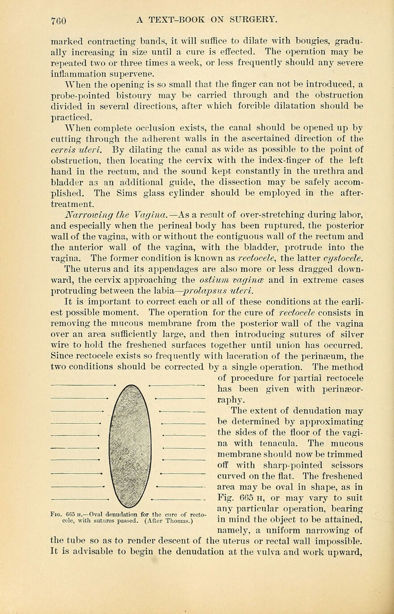 marked contracting bands, it will suffice to dilate with bougies, gradu- ally increasing in size until a cure is effected. The operation may be repeated two or three times a week, or less frequently should any severe inflammation supervene. When the opening is so small that the finger can not be introduced, a probe-pointed bistoury may be carried through and the obstruction divided in several directions, after which forcible dilatation should be practiced. When complete occlusion exists, the canal should be ojDened up by cutting through the adherent walls in the ascertained direction of the cervis uteri. By dilating the canal as wide as possible to the point of obstruction, then locating the cervix with the index-finger of the left hand in the rectum, and the sound kept constantly in the urethra and bladder as an additional guide, the dissection may be safely accom- plished. The Sims glass cylinder should be employed in the after- treatment. Narrowing the Vagina.—As a result of over-stretching during labor, and especially when the perineal body has been ruptured, the posterior wall of the vagina, with or without the contiguous wall of the rectum and the anterior wall of the vagina, with the bladder, protrude into the vagina. The former condition is known as rectocele, the latter cystocele. The uterus and its appendages are also more or less dragged down- ward, the cervix approaching the ostium vagin(B and in extreme cases I)rotruding between the Idtbia.—prolapsus uteri. It is important to correct each or all of these conditions at the earli- est possible moment. The operation for the cure of rectocele consists in removing the mucous membrane from the posterior wall of the vagina over an area sufficiently large, and then introducing sutures of silver wire to hold the freshened surfaces together until union has occurred. Since rectocele exists so frequently with laceration of the perinseum, the two conditions should be corrected by a single operation. The method of procedure for partial rectocele has been given with peringeor- raphy. The extent of denudation may be determined by approximating the sides of the floor of the vagi- na with tenacula. The mucous membrane shoiild now be trimmed ofl with sharp-pointed scissors curved on the flat. The freshened area may be oval in shape, as in Fig. 665 H, or may vary to suit any particular operation, bearing in mind the object to be attained, namely, a uniform narrowing of the tube so as to render descent of the uterus or rectal wall impossible. It is advisable to begin the denudation at the vulva and work upward, Fio. 665 H.—Oval denudation for the cure of recto- cele, ■with sutures passed. (After Thomas.)