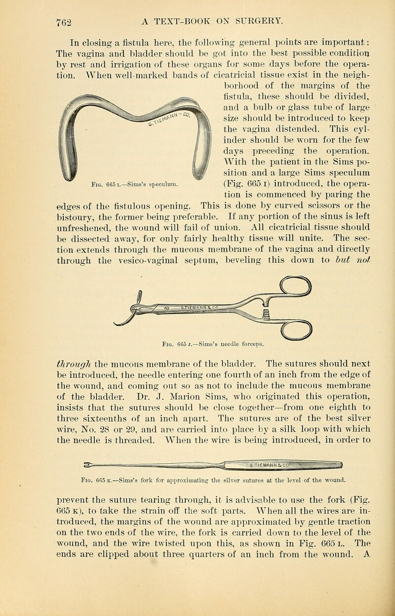 In closing a fistula here, the following general points are important: The vagina and bladder should be got into the best possible condition by rest and irrigation of these organs for some days before the opera- tion. When well-marked bands of cicatricial tissue exist in the neigh- borhood of the margins of the fistula, these should be divided, and a bulb or glass tube of large size should be introduced to keep the vagina distended. This cyl- inder should be worn for the few days preceding the operation. With the patient in the Sims po- sition and a large Sims speculum (Fig. 665 i) introduced, the opera- tion is commenced by paring the edges of the fistulous opening. This is done by curved scissors or the bistoury, the former being preferable. If any portion of the sinus is left unfreshened, the wound will fail of union. All cicatricial tissue should be dissected away, for only fairly healthy tissue will unite. The sec- tion extends through the mucous membrane of the vagina and directly through the vesico-vaginal septum, beveling this down to hut not Fig. 6651.—Sims's speculun Fig. 665 j.—Sims's needle forceps. tJirougTi the mucous membrane of the bladder. The sutures should next be introduced, the needle entering one fourth of an inch from the edge of the wound, and coming out so as not to include the mucous membrane of the bladder. Dr. J. Marion Sims, who originated this operation, insists that the sutures should be close together—from one eighth to three sixteenths of an inch apart. The sutures are of the best silver wire, No. 28 or 29, and are carried into place by a silk loop with which the needle is threaded. When the wire is being introduced, in order to IE (WAN N a>-CpiBB™teBr; Fio. 665 TS..—Sims's fork for approximating the silver sutures at the level of the wound. prevent the suture tearing through, it is advisable to use the fork (Fig. 665 K), to take the strain off the soft parts. When all the wires are in- troduced, the margins of the wound are approximated by gentle traction on the two ends of the wire, the fork is carried down to the level of the wound, and the wire twisted upon this, as shown in Fig. 665 L. The ends are clipped about three quarters of an inch from the wound. A