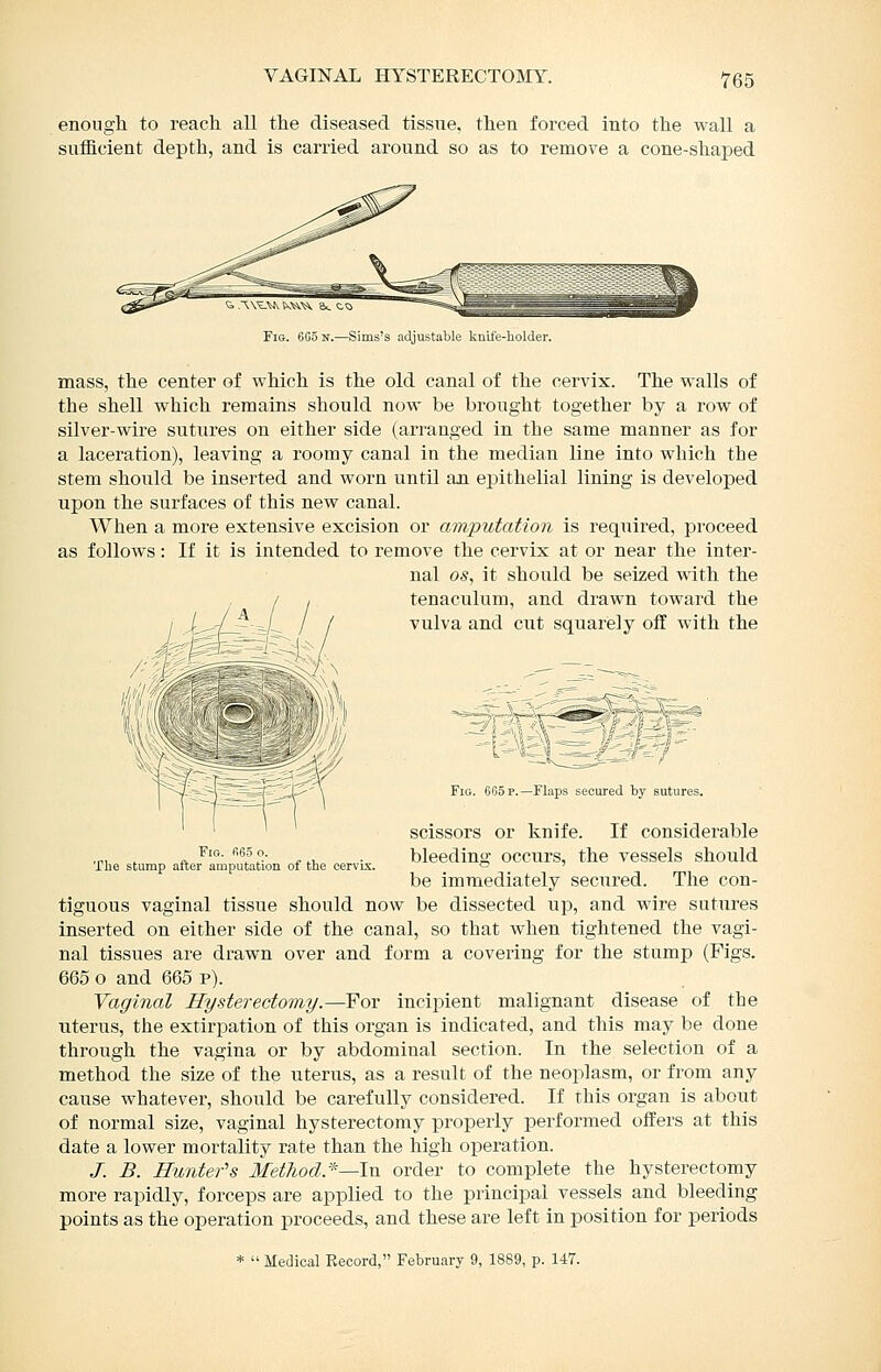 enougli to reach all the diseased tissue, then forced into the wall a sufficient depth, and is carried around so as to remove a cone-shaped Fig. 605 jr.—Sims's adjustable kniie-holder. mass, the center of which is the old canal of the cervix. The walls of the shell which remains should now be brought together by a row of silver-wire sutures on either side (arranged in the same manner as for a laceration), leaving a roomy canal in the median line into which the stem should be inserted and worn until an ei^ithelial lining is developed upon the surfaces of this new canal. When a more extensive excision or amq)utation is required, proceed as follows: If it is intended to remove the cervix at or near the inter- nal OS, it should be seized with the tenaculum, and drawn toward the vulva and cut squarely off with the Fig. fi6.5 o. The stump after amputation of the cervbc. Fig. 665 p.—Flaps secured by sutures. scissors or knife. If considerable bleeding occurs, the vessels should be immediately secured. The con- tiguous vaginal tissue should now be dissected up, and wire sutures inserted on either side of the canal, so that when tightened the vagi- nal tissues are drawn over and form a covering for the stump (Figs. 665 o and 665 p). Vaginal Hysterectomy.—For incipient malignant disease of the uterus, the extirpation of this organ is indicated, and this may be done through the vagina or by abdominal section. In the selection of a method the size of the uterus, as a result of the neoplasm, or from any cause whatever, should be carefully considered. If this organ is about of normal size, vaginal hysterectomy properly performed offers at this date a lower mortality rate than the high operation. J. B. Hunter's MetJiod*~ln order to complete the hysterectomy more rapidly, forceps are applied to the principal vessels and bleeding points as the operation proceeds, and these are left in position for periods *  Medical Record, February 9, 1889, p. 147.