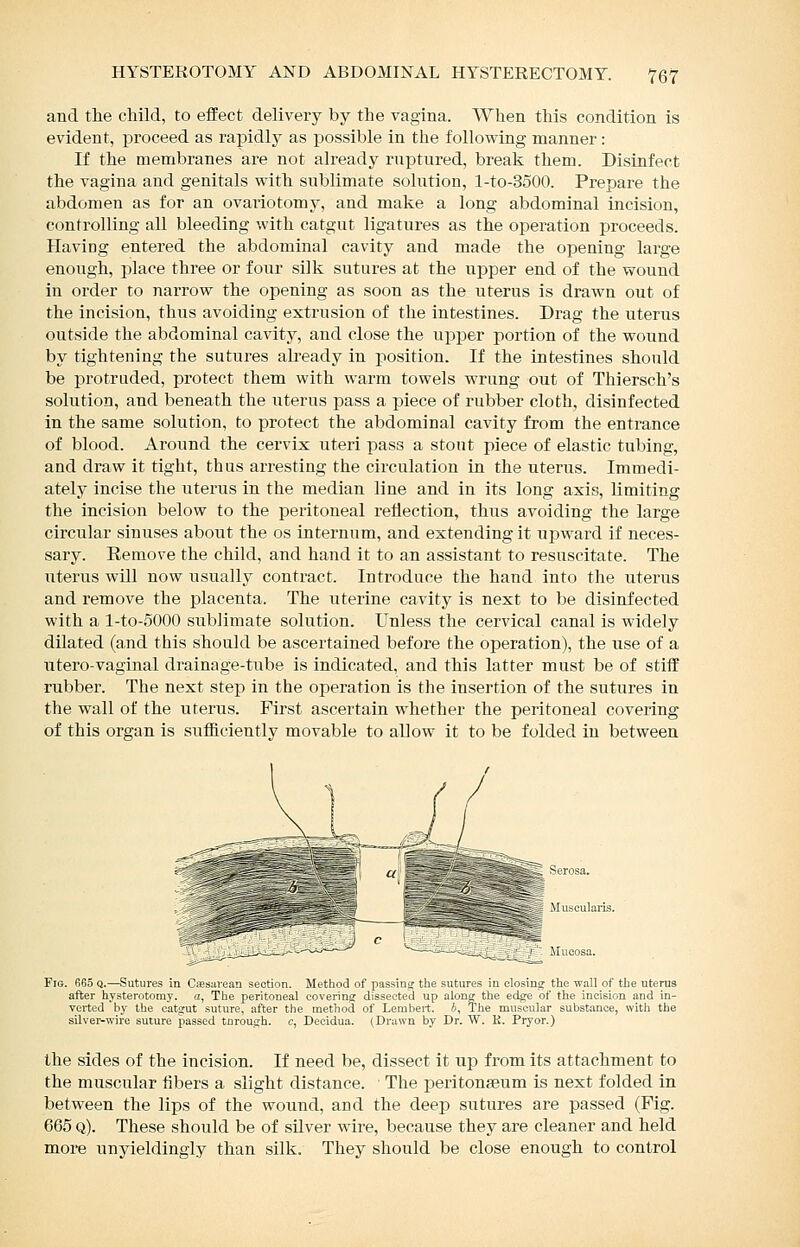 and the child, to effect delivery by the vagina. When this condition is evident, proceed as rapidly as possible in the following manner: If the membranes are not already ruptured, break them. Disinfect the vagina and genitals with sublimate solution, l-to-3500. Prepare the abdomen as for an ovariotomy, and make a long abdominal incision, controlling all bleeding with catgut ligatures as the operation proceeds. Having entered the abdominal cavity and made the opening large enough, place three or four silk sutures afc the upper end of the wound in order to narrow the opening as soon as the uterus is drawn out of the incision, thus avoiding extrusion of the intestines. Drag the uterus outside the abdominal cavity, and close the upjDer portion of the wound by tightening the sutures akeady in position. If the intestines should be protruded, protect them with warm towels wrung out of Thiersch's solution, and beneath the uterus pass a piece of rubber cloth, disinfected in the same solution, to protect the abdominal cavity from the entrance of blood. Around the cervix uteri pass a stout piece of elastic tubing, and draw it tight, thus arresting the circulation in the uterus. Immedi- ately incise the uterus in the median line and in its long axis, limiting the incision below to the peritoneal reflection, thus avoiding the large circular sinuses about the os internum, and extending it ujjward if neces- sary. Eemove the child, and hand it to an assistant to resuscitate. The uterus will now usually contract. Introduce the hand into the uterus and remove the placenta. The uterine cavity is next to be disinfected with a l-to-5000 sublimate solution. Unless the cervical canal is widely dilated (a,nd this should be ascertained before the operation), the use of a utero-vaginal drainage-tube is indicated, and this latter must be of stiflf rubber. The next step in the operation is the insertion of the sutures in the wall of the uterus. First ascertain whether the peritoneal covering of this organ is siifficiently movable to allow it to be folded in between -f- Mucosa. Fio. 665 Q.—Sutures in Csesavean section. Method of passins; tlie sutures in closine: the wall of the uterus after hysterotomy, a, The peritoneal coverinsr dissected up along the edge of the incision and in- verted by the catgut suture, after the method of Lembert. b. The muscular substance, with the silvei^wire suture passed tnrough. c, Decidua. (Drawn by Dr. W. K. Pryor.) the sides of the incision. If need be, dissect it up from its attachment to the muscular fibers a slight distance. The peritonjBum is next folded in between the lips of the woimd, and the deep sutures are passed (Fig. 665 q). These should be of silver wire, because they are cleaner and held more unyieldingly than silk. They should be close enough to control