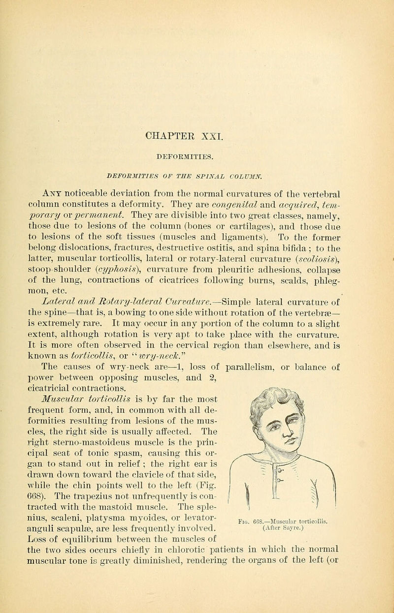 CHAPTEE XXI. DEFORMITIES. DEFORMITIES OF THE SPINAL COLUMN. A.WZ noticeable deviation from the normal curvatures of the vertebral column constitutes a deformity. They are congenital and acquired, tem- porary or permanent. They are divisible into tvs^o great classes, namely, those due to lesions of the column (bones or cartilages), and those due to lesions of the soft tissues (muscles and ligaments). To the former belong dislocations, fractures, destructive ostitis, and sijina bifida ; to the latter, muscular torticollis, lateral or rotary-lateral curvature {scoliosis), stoop-shoulder {cyphosis), curvature from pleuritic adhesions, collapse of the lung, contractions of cicatrices following burns, scalds, phleg- mon, etc. Lateral and Rotary-lateral Curvature.—Simple lateral curvature of the spine—that is, a bowing to one side without rotation of the vertebrae- is extremely rare. It may occur in any portion of the column to a slight extent, although rotation is very apt to take place with the curvature. It is more often observed in the cervical region than elsewhere, and is known as torticollis, or '' lory-necJc. The causes of wry-neck are—1, loss of parallelism, or balance of power between opposing muscles, and 2, cicatricial contractions. Muscular torticollis is by far the most frequent foi'm, and, in common with all de- formities resulting from lesions of the mus- cles, the right side is usually affected. The right sterno-mastoideus muscle is the prin- cipal seat of tonic spasm, causing this or- gan to stand out in relief ; the right ear is drawn down toward the clavicle of that side, while the chin points well to the left (Fig. 668). The trapezius not unfrequently is con- tracted with the mastoid muscle. The sple- nius, scaleni, platysma myoides, or levator- anguli scapulse, are less frequently involved. Loss of equilibrium between the muscles of the two sides occurs chiefly in chlorotic patients in which the normal muscular tone is greatly diminished, rendering the organs of the left (or Fig. 6G8.—MuBCubi- torticollis. (After Sayre.)