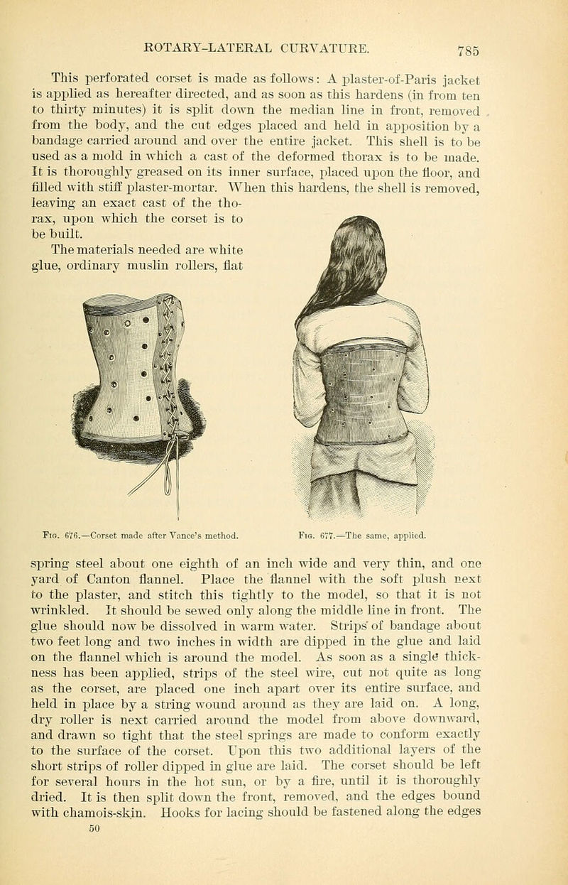 This perforated corset is made as follows: A plaster-of-Paris jacket is applied as hereafter directed, and as soon as this hardens (in from ten to thirty minutes) it is split down the median line in front, removed from the body, and the cut edges placed and held in apposition by a bandage carried around and over the entire jacket. This shell is to be used as a mold in which a cast of the deformed thorax is to be made. It is thoroughly greased on its inner surface, jilaced ujDon the floor, and filled with stifl' j)laster-mortar. When this hardens, the shell is removed, leaving an exact cast of the tho- rax, iipon which the corset is to be built. The materials needed are white glue, ordinary muslin rollers, flat Fig. 6T6.—Corset made after Vance's method. Fig. 6V7.—The same, applied. spring steel about one eighth of an inch wide and very thin, and one yard of Canton flannel. Place the flannel with the soft plush next to the plaster, and stitch this tightly to the model, so that it is not wrinkled. It should be sewed only along the middle line in fi'ont. The glue should now be dissolved in warm water. Strips of bandage about two feet long and two inches in width are dipped in the glue and laid on the flannel which is around the model. As soon as a single thick- ness has been applied, strips of the steel wire, cut not quite as long as the corset, are placed one inch apart over its entire surface, and held in place by a string wound around as they are laid on. A long, dry roller is next carried around the model from above downward, and drawn so tight that the steel springs are made to conform exactly to the surface of the corset. Upon this two additional layers of the short strips of roller dipped in glue are laid. The corset should be left for several hours in the hot sun, or by a fire, until it is thoroughly dried. It is then split down the front, removed, and the edges bound with chamois-skin. Hooks for lacing should be fastened along the edges 50