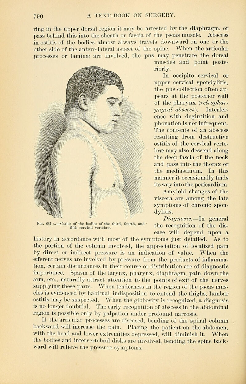 ring in the upper dorsal region it may be arrested by the diaphragm, or pass behind this into the sheath or fascia of the psoas muscle. Abscess in ostitis of the bodies almost always travels downward on one or the other side of the antero-lateral aspect of the spine. When the articular processes or laminse are involved, the pus may penetrate the dorsal muscles and point poste- riorly. In occipito-cervical or upper cervical spondylitis, the pus collection often ap- pears at the posterior wall of the pharynx (^etropTiar- yngeal abscess). Interfer- ence with deglutition and phonation is not infrequent. The contents of an abscess resulting from destructive ostitis of the cervical verte- brae may also descend along the deep fascia of the neck and pass into the thorax or the mediastinum. In this manner it occasionally iinds its way into the pericardium. Amyloid changes of the viscera are among the late symptoms of chronic spon- dylitis. Diagnosis.—In general the recognition of the dis- ease will depend upon a history in accordance with most of the symptoms just detailed. As to the portion of the column involved, the axopreciation of localized pain by direct or indirect pressure is an indication of value. When the efferent nerves are involved by pressure from the products of inflamma- tion, certain disturbances in their course or distribution are of diagnostic importance. Spasm of the larynx, pharynx, diaphragm, pain down the arm, etc., naturally attract attention to the points of exit of the nerves supplying these parts. When tenderness in the region of the psoas mus- cles is evidenced by habitual indisposition to extend the thighs, lumbar ostitis may be suspected. When the gibbosity is recognized, a diagnosis is no longer doubtful. The early recognition of abscess in the abdominal region is possible only by palpation under profound narcosis. If the articular processes are diseased, bending of the spinal column backward will increase the pain. Placing the patient on the abdomen, with the head and lower extremities depressed, will diminish it. When the bodies and intervertebral disks are involved, bending the spine back- ward will relieve the pressure symptoms. Fig. 681 a.—Caries of the bodies of the third, fourth, and ■ fifth cervical vertcbrffi.