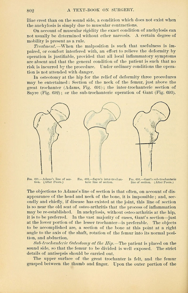 iliac crest than on the sound side, a condition which does not exist when the anchylosis is simply due to muscular contractions. On account of muscular rigidity the exact condition of anchylosis can not usually be determined without ether narcosis. A certain degree of mobility is present as a rule. Treatment.—When the malposition is such that usefulness is im- paired, or comfort interfered with, an effort to relieve the deformity by operation is justifiable, provided that all local inflammatory symptoms are absent and that the general condition of the patient is such that no risk is incurred by the procedure. Under ordinary conditions the ojDera- tion is not attended with danger. In osteotomy at the hip for the relief of deformity three procedures may be entertained : Section of the neck of the femur, just above the great trochanter (Adams, Fig. 691); the inter-trochanteric section of Sayre (Fig. 692); or the sub-trochanteric operation of Gant (Fig. 693). Fig. 691.—Adams's line of sec- tion. (After Poore.) Fig. 692.—Sayre's inter-trocl}an- terio line of section. Fig. 693.—Gant's sub-tvoclianteric line of section. (After Poore.) The objections to Adams's line of section is that often, on account of dis- appearance of the head and neck of the bone, it is impossible ; and, sec- ondly and chiefly, if disease has existed at the joint, this line of section is so near the old seat of osteo-arthritis that the process of inflammation may be re-established. In anchylosis, without osteoarthritis at the hip, it is to be preferred. In the vast majority of cases, Gant's section—just at the lower portion of the lesser trochanter—is preferable. The objects to be accomplished are, a section of the bone at this point at a right angle to the axis of the shaft, rotation of the femur into its normal posi- tion, and abduction. Siib-trochanteric Osteotomy at tlie Hip.—The patient is placed on the sound side, so that the femur to be divided is well exposed. The strict details of antisepsis should be carried out. The upper surface of the great trochanter is felt, and the femur grasped between the thumb and finger. Upon the outer portion of the