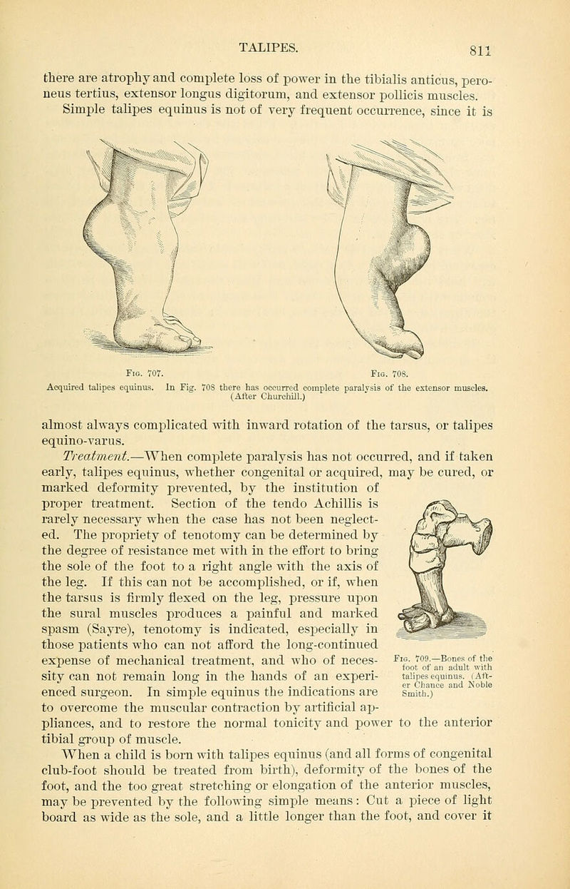 TALIPES. there are atrophy and complete loss of power in the tibialis anticus, pero- neus tertius, extensor longus digitorum, and extensor poUicis muscles. Simple talipes equinus is not of very frequent occurrence, since it is Fig tot Acquired talipes equinus. In Fig 708 there has occurred complete paralysis of the extensor muscles. (After Churchill.) almost always complicated with inward rotation of the tarsus, or talipes equino-varus. Treatment.—When complete paralysis has not occurred, and if taken early, talipes equinus, whether congenital or acquired, may be cured, or marked deformity prevented, by the institution of proper treatment. Section of the tendo Achillis is rarely necessary when the case has not been neglect- ed. The propriety of tenotomy can be determined by the degree of resistauce met with in the effort to bring the sole of the foot to a right angle with the axis of the leg. If this can not be accomplished, or if, when the tarsus is firmly flexed on the leg, pressure upon the sural muscles produces a painful and marked spasm (Sayre), tenotomy is indicated, es^Decially in those patients who can not afford the long-continued expense of mechanical treatment, and who of neces- sity can not remain long in the hands of an experi- enced surgeon. In simjjle equinus the indications are to overcome the muscular contraction by artificial ap- pliances, and to restore the normal tonicity and power to the anterior tibial group of muscle. When a child is bom with talipes equinus (and all forms of congenital club-foot should be treated from birth), deformity of the bones of the foot, and the too great stretching or elongation of the anterior muscles, may be prevented by the following simple means: Cut a piece of light board as wide as the sole, and a little longer than the foot, and cover it Fig. T09.—Bones of the foot of an adult with talipes equinus. (Aft- er Chance and Noble Smith.)