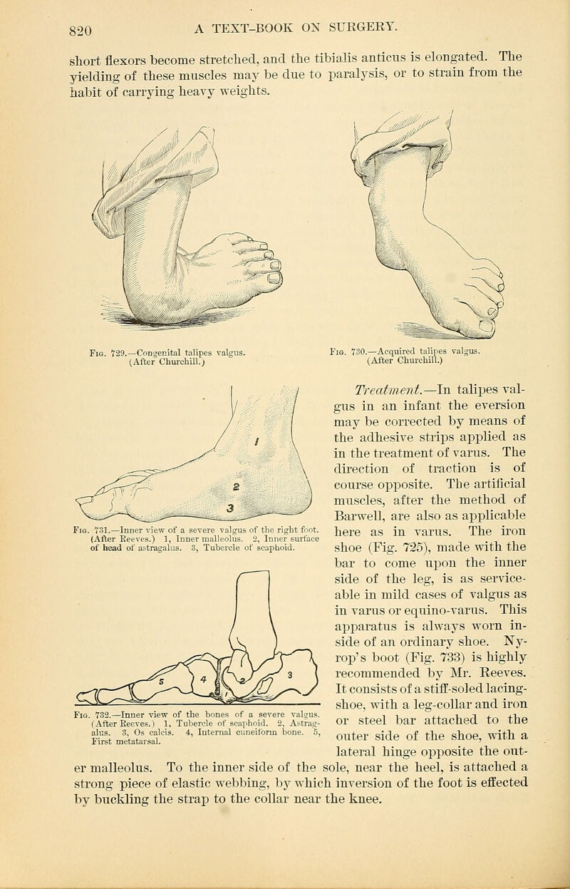 short flexors become stretched, and the tibialis anticus is elongated. The yielding of these muscles may be due to paralysis, or to strain from the habit of carrying heavy weights. j^i_,„V Fig. 729.—Congenital talipes valgus. (After Churchill.) Fig. T30.—Acquired talipes valgus. (After Churchill.) Fig. 731.—Inner view of a severe valgus of the right foot. (After Eeeves.) 1, Inner malleolus. 2, Inner surface of head of astragalus. 3, Tubercle of scaphoid. Treatment.—In talipes val- gus in an infant the eversion may be corrected by means of the adhesive strips applied as in the treatment of varus. The dii'ection of traction is of course opposite. The artificial muscles, after the method of Barwell, are also as applicable here as in varus. The iron shoe (Fig. 725), made with the bar to come upon the inner side of the leg, is as service- able in mild cases of valgus as in varus or equino-varus. This apparatus is always worn in- side of an ordinary shoe. ISTy- rop's boot (Fig. 733) is highly recommended by Mr. Reeves. It consists of a stiff-soled lacing- shoe, with a leg-collar and iron or steel bar attached to the outer side of the shoe, with a lateral hinge opposite the out- er malleolus. To the inner side of the sole, near the heel, is attached a strong piece of elastic webbing, by which inversion of the foot is effected by buckling the strap to the collar near the knee. Fig. 732.—Inner view of tie bones of a severe valgus. (After Eeeves.) 1, Tubercle of scaphoid. 2, Astrag- alus. 3, Os calcis. 4, Internal cuneiform bone. 5, First metatarsal.