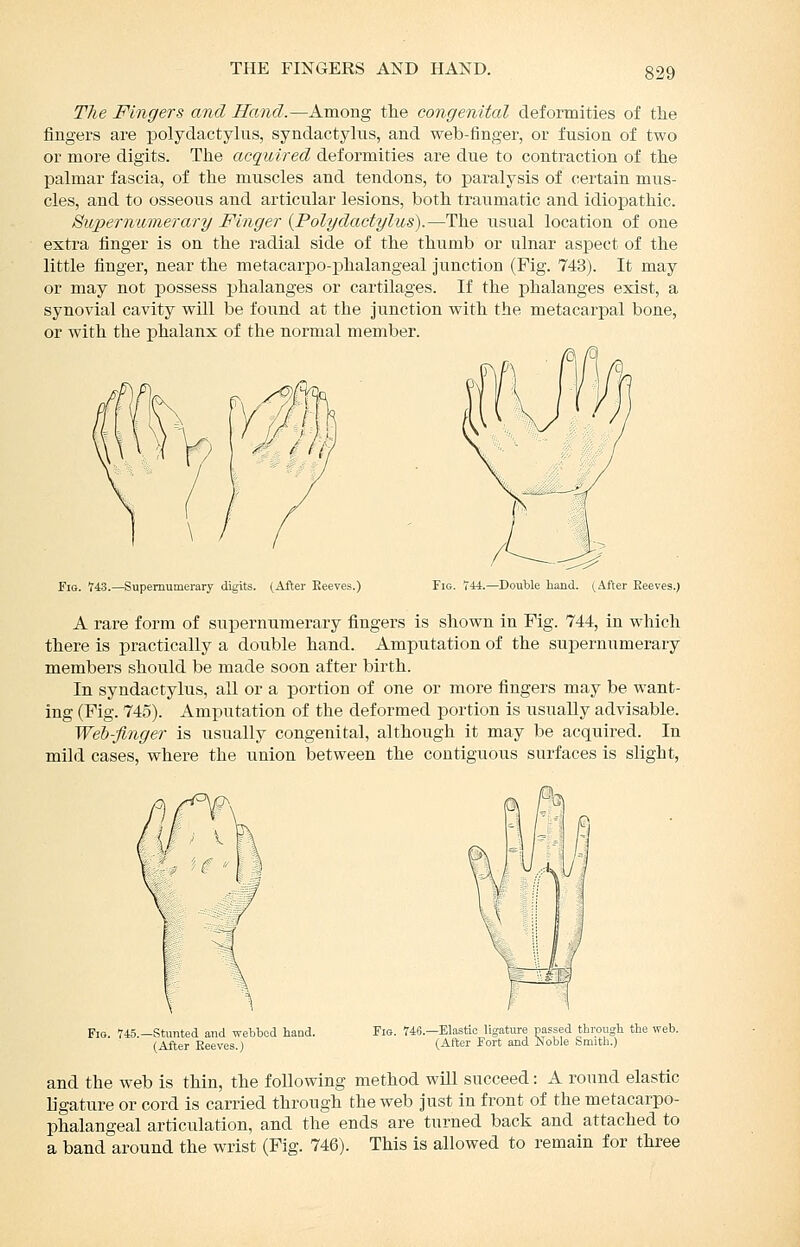 THE FINGERS AND HAND. The Fingers and Hand.—Among the congenital deformities of the fingers are polydactylus, syndactylus, and web-finger, or fusion of two or more digits. The acquired deformities are due to contraction of the palmar fascia, of the muscles and tendons, to paralysis of certain mus- cles, and to osseous and articular lesions, both traumatic and idiopathic. 8u2>ernumerary Finger {Polydactylus).—The usual location of one extra finger is on the radial side of the thumb or ulnar aspect of the little finger, near the metacarpo-phalangeal junction (Fig. 743). It may or may not possess phalanges or cartilages. If the j)halanges exist, a synovial cavity will be found at the junction with the metacarpal bone, or with the phalanx of the normal member. Fig. 743.—Supernumerary digits. (After Keeves.) Fig. la.—Doutle hand. (After Eeeves.J A rare form of supernumerary fingers is shown in Fig. 744, in which there is practically a double hand. Amputation of the supernumerary members should be made soon after birth. In syndactylus, all or a portion of one or more fingers may be want- ing (Fig. 745). Amputation of the deformed portion is usually advisable. Weh-finger is usually congenital, although it may be acquired. In mild cases, where the union between the contiguous surfaces is slight, Fig. 745.—Stunted and webbed haud. (After Keeves.) Fig. 746.—Elastic ligature passed through the web. (After Fort and Noble Smitlu) and the web is thin, the following method will succeed: A round elastic ligature or cord is carried through the web just in front of the metacarpo- phalangeal articulation, and the ends are turned back and attached to a band around the wrist (Fig. 746). This is allowed to remain for three