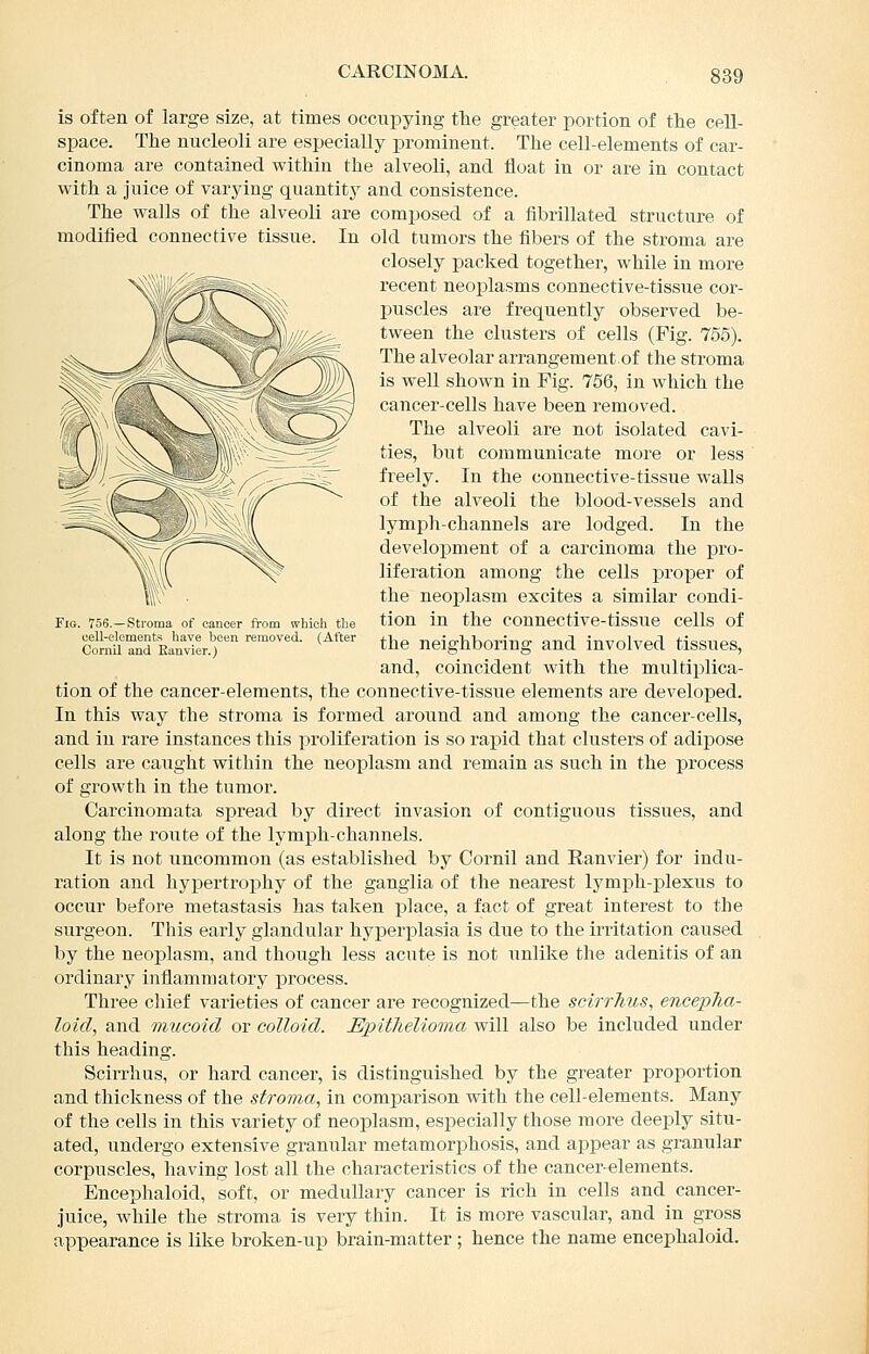 CARCINOMA. Fig. 756.—Stroma of cancer from which the cell-elements have been removed. (After Comil and Eanvier.) is often of large size, at times occupying tte greater portion of the cell- space. The nucleoli are especially prominent. The cell-elements of car- cinoma are contained within the alveoli, and float in or are in contact with a juice of varying quantity and consistence. The walls of the alveoli are composed of a fibrillated structure of modified connective tissue. In old tumors the fibers of the stroma are closely packed together, while in more recent neoplasms connective-tissue cor- puscles are frequently observed be- tween the clusters of cells (Fig. 755). The alveolar arrangement of the stroma is well shown in Fig. 756, in which the cancer-cells have been removed. The alveoli are not isolated cavi- ties, but communicate more or less freely. In the connective-tissue walls of the alveoli the blood-vessels and lymph-channels are lodged. In the development of a carcinoma the pro- liferation among the cells proper of the neojDlasm excites a similar condi- tion in the connective-tissue cells of the neighboring and involved tissues, and, coincident with the multiplica- tion of the cancer-elements, the connective-tissue elements are developed. In this way the stroma is formed around and among the cancer-cells, and in rare instances this proliferation is so rapid that clusters of adipose cells are caught within the neoplasm and remain as such in the process of growth in the tumor. Carcinomata spread by direct invasion of contiguous tissues, and along the route of the lymph-channels. It is not uncommon (as established by Cornil and Ranvier) for indu- ration and hypertrophy of the ganglia of the nearest lymjDh-plexus to occur before metastasis has taken place, a fact of great interest to the surgeon. This early glandular hyperplasia is due to the irritation caiised by the neoplasm, and though less acute is not unlike the adenitis of an ordinary inflammatory process. Three chief varieties of cancer are recognized—the scirrTius, enceplia- loid, and mucoid or colloid. EpitlieUoma will also be included under this heading. Scirrhus, or hard cancer, is distinguished by the greater proportion and thickness of the stroma, in comparison with the cell-elements. Many of the cells in this variety of neoplasm, especially those more deeply situ- ated, undergo extensive granular metamorphosis, and appear as granular corpuscles, having lost all the characteristics of the cancer-elements. Encephaloid, soft, or medullary cancer is rich in cells and cancer- juice, while the stroma is very thin. It is more vascular, and in gross appearance is like broken-up brain-matter ; hence the name encephaloid.