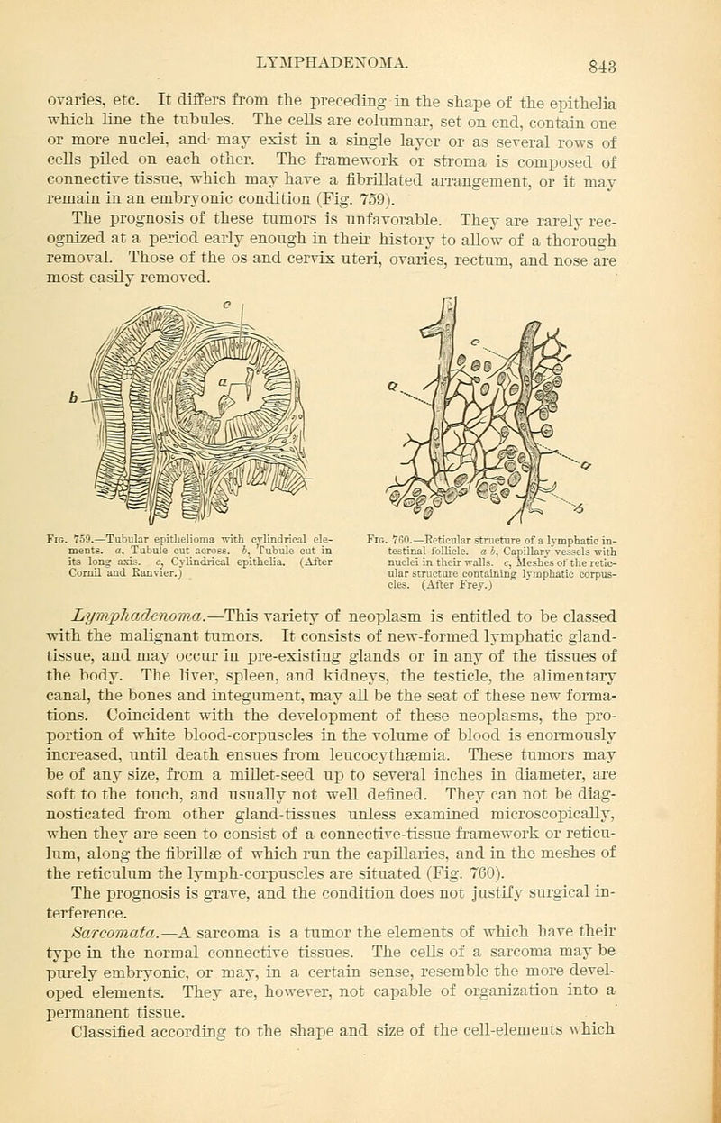 lt:mphadexoma. OTaries, etc. It differs from the preceding in the shape of the epithelia which line the tubules. The cells are columnar, set on end, contain one or more nuclei, and- may exist in a single layer or as several rows of cells piled on each other. The framework or stroma is composed of connective tissue, which may have a fibrillated an-angement, or it may remain in an embryonic condition (Fig. 759). The prognosis of these tumors is unfavorable. They are rarely rec- ognized at a period early enough in their history to allow of a thorough removal. Those of the os and cervix uteri, ovaries, rectum, and nose are most easily removed. Fig. T59.—Tubular epithelioma ■nith cvlindrical ele- ments, a. Tubule cut across. 6, 'Cubule cut in its long axis, c^ Cylindrical epithelia. (After Coruil and Eanvier.j Fig. too.—Eeticular structure of a lymphatic in- testinal follicle, a i. Capillary vessels with nuclei in their walls, c, ileshes of the retic- ular structure containing lymphatic corpus- cles. (Aiter Frey.) LympTiadenoma.—This variety of neoplasm is entitled to be classed with the malignant tumors. It consists of new-formed lymphatic gland- rissue, and may occur in pre-existing glands or in any of the tissues of the body. The liver, spleen, and kidneys, the testicle, the alimentary canal, the bones and integument, may all be the seat of these new forma- tions. Coincident with the development of these neoplasms, the pro- portion of white blood-corpuscles in the volume of blood is enoiTQously increased, until death ensues from leucocythaemia. These tumors may be of any size, from a millet-seed up to several inches in diameter, are soft to the touch, and usually not well defined. They can not be diag- nosticated from other gland-tissues unless examined microscopically, when they are seen to consist of a connective-tissue framework or reticu- lum, along the fibrillse of which run the capillaries, and in the meshes of the reticulum the lymph-corpuscles are situated (Fig. 760). The prognosis is grave, and the condition does not justify surgical in- terference. Sarcoraata.—A sarcoma is a tumor the elements of which have their type in the normal connective tissues. The cells of a sarcoma may be purely embryonic, or may, in a certain sense, resemble the more devel- oped elements. They are, however, not callable of organization into a permanent tissue. Classified according to the shape and size of the cell-elements which