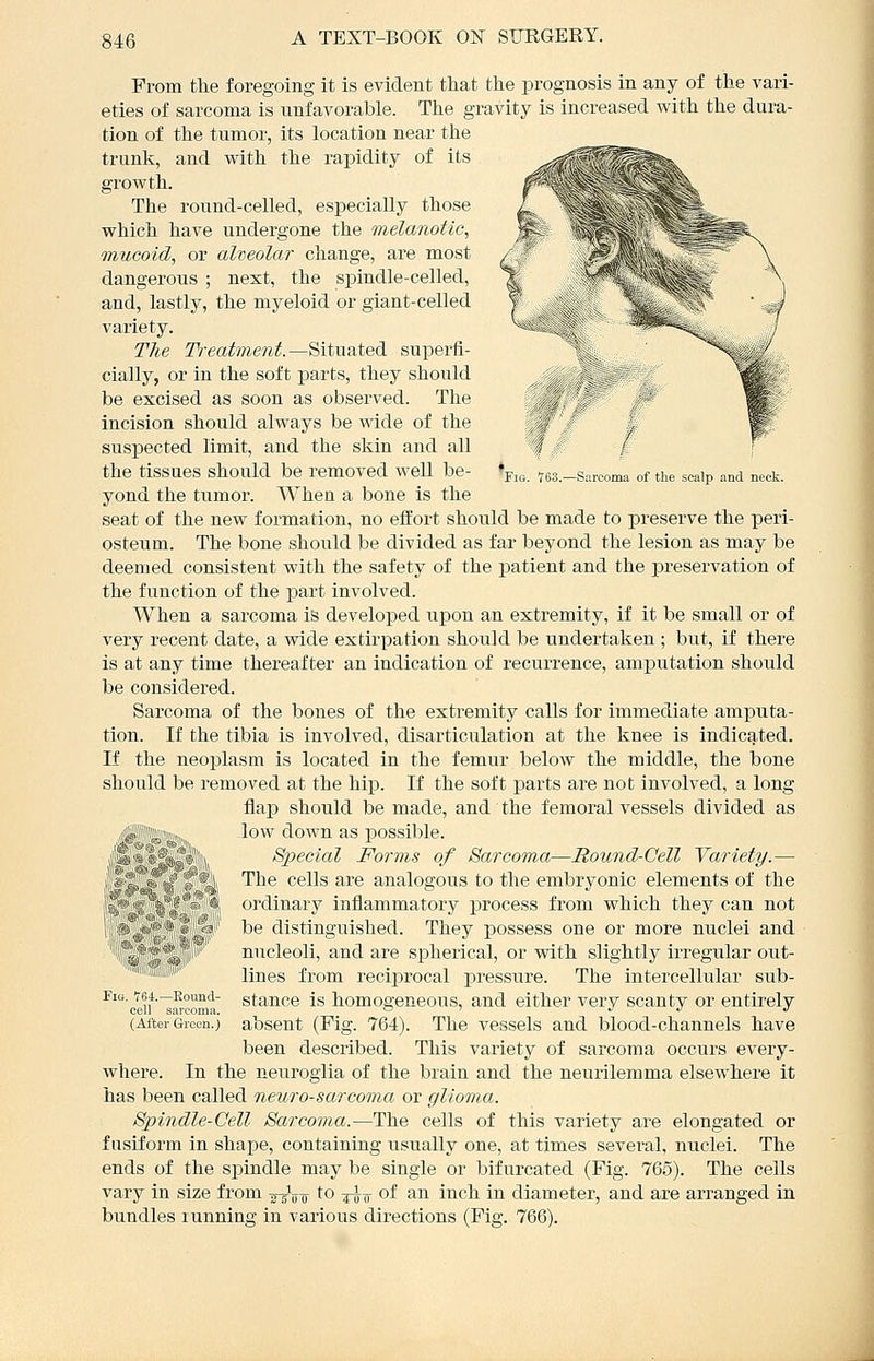 -Sarcoma of the scalp and neck. From tlie foregoing it is evident that tlie prognosis in any of the vari- eties of sarcoma is unfavorable. The gravity is increased with the dura- tion of the tumor, its location near the trunk, and vi^ith the rapidity of its growth. The round-celled, especially those which have undergone the melanotic, mueoid, or alveolar change, are most dangerous ; next, the spindle-celled, and, lastly, the myeloid or giant-celled variety. The Treatment.—Situated superfi- cially, or in the soft parts, they should be excised as soon as observed. The incision should always be wide of the suspected limit, and the skin and all the tissues should be removed well be- yond the tumor. AVhen a bone is the seat of the new formation, no effort should be made to preserve the peri- ostenm. The bone should be divided as far beyond the lesion as may be deemed consistent with the safety of the patient and the preservation of the function of the part involved. When a sarcoma is developed upon an extremity, if it be small or of very recent date, a wide extirpation should be undertaken ; but, if there is at any time thereafter an indication of recurrence, amputation should be considered. Sarcoma of the bones of the extremity calls for immediate amputa- tion. If the tibia is involved, disarticulation at the knee is indicated. If the neoplasm is located in the femur below the middle, the bone should be removed at the hip. If the soft parts are not involved, a long flap should be made, and the femoral vessels divided as (igSlgini,, ,^ -low down as possible. Special Forms of Sarcoma—Round-Cell Variety.— The cells are analogous to the embryonic elements of the ordinary inflammatory process from which they can not be distinguished. They possess one or more nuclei and micleoli, and are spherical, or with slightly irregular out- lines from reciprocal pressure. The intercellular sub- stance is homogeneous, and either very scanty or entirely absent (Fig. 764). The vessels and blood-channels have been described. This variety of sarcoma occurs every- where. In the neuroglia of the brain and the neurilemma elsewhere it has been called neurosarcoma or glioma. Spindle-Cell Sarcoma.—The cells of this variety are elongated or fusiform in shape, containing usually one, at times several, nuclei. The ends of the spindle may be single or bifurcated (Fig. 765). The cells vary in size from ^-g^-^ to too of ^^'^ inch in diameter, and are arranged in bundles running in various directions (Fig. 766). ■:\^ Fia. V64.—Eound- cell sarcoma. (After Grocn.;