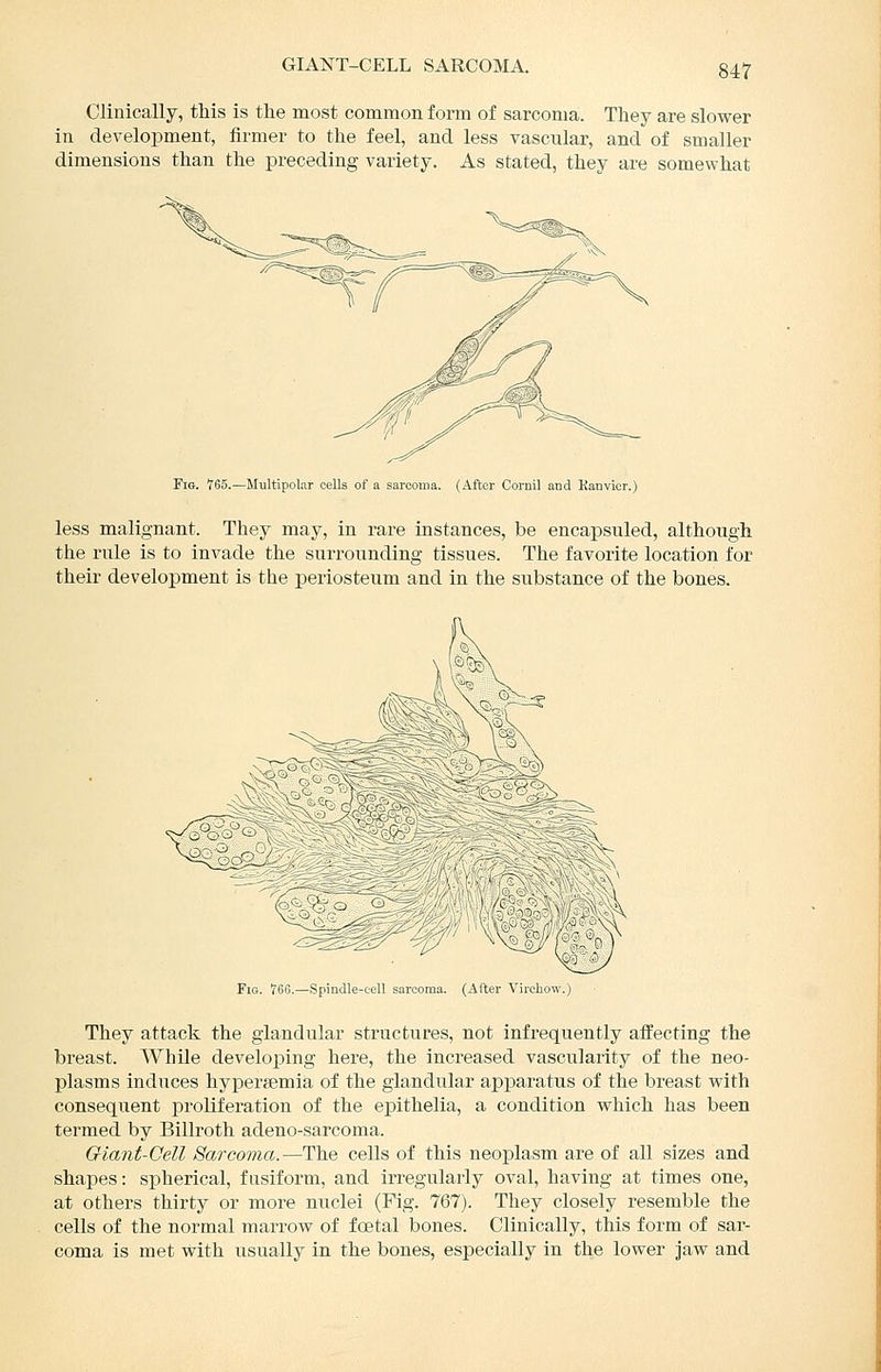 GIANT-CELL SARCOMA. Clinically, this is the most common form of sarcoma. They are slower in development, firmer to the feel, and less vascular, and of smaller dimensions than the preceding variety. As stated, they are somewhat Fig. 765.—Multipolar cells of a sarcoma. (After Cornil and Kanvlcr.) less malignant. They may, in rare instances, be encapsuled, although the rule is to invade the surrounding tissues. The favorite location for their development is the periosteum and in the substance of the bones. Fig. 760.—Spindle-cell sarcoma. (After Vii-chow.) They attack the glandular structures, not infrequently affecting the breast. While developing here, the increased vascularity of the neo- plasms induces hyperemia of the glandular apparatus of the breast with consequent proliferation of the epithelia, a condition which has been termed by Billroth adeno-sarcoma. Giant-Gell Sarcoma.—The cells of this neoplasm are of all sizes and shapes: spherical, fnsiform, and irregularly oval, having at times one, at others thirty or more nuclei (Fig. 767). They closely resemble the cells of the normal marrow of foetal bones. Clinically, this form of sar- coma is met with usually in the bones, especially in the lower jaw and