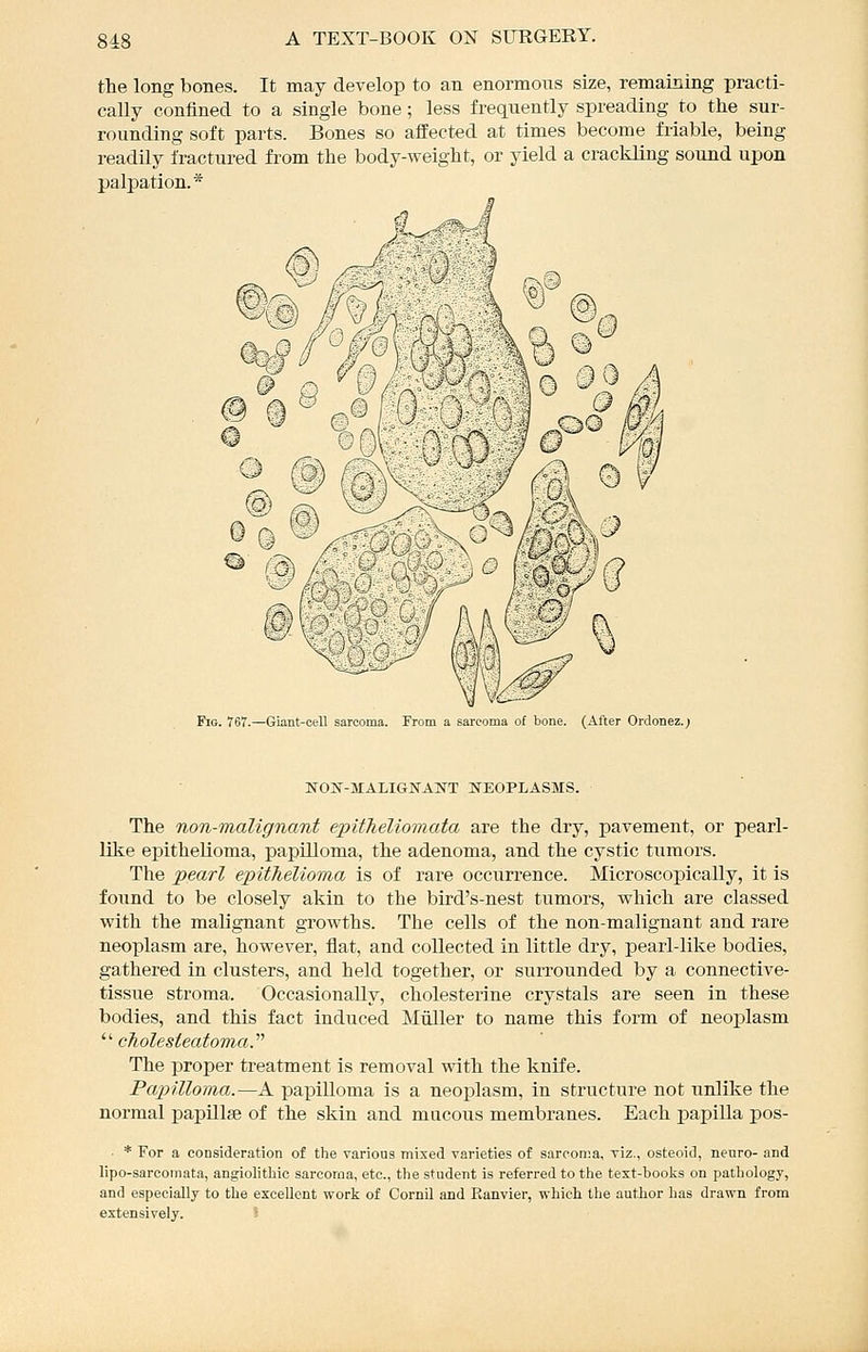 the long bones. It may develop to an enormous size, remaining practi- cally confined to a single bone; less frequently spreading to the sur- rounding soft parts. Bones so affected at times become friable, being readily fractured from the body-weight, or yield a crackling sound upon palpation.* Fig. 767.—Giant-cell sarcoma. From a sarcoma of bone. (After Ordonez.; NON-MALIGNANT NEOPLASMS. The non-malignant epitheUomata are the dry, pavement, or pearl- like epithelioma, papilloma, the adenoma, and the cystic tumors. The pearl epithelioma is of rare occurrence. Microscopically, it is found to be closely akin to the bird's-nest tumors, which are classed with the malignant growths. The cells of the non-malignant and rare neoplasm are, however, flat, and collected in little dry, pearl-like bodies, gathered in clusters, and held together, or surrounded by a connective- tissue stroma. Occasionally, cholesterine crystals are seen in these bodies, and this fact induced Miiller to name this form of neoplasm '■'•cholesteatoma.'''' The proper treatment is removal with the knife. Papilloma.—A pa]pilloma is a neoplasm, in structure not unlike the normal papillse of the skin and mucous membranes. Each papilla pos- • * For a consideration of the varioaa mixed varieties of sarcoma, viz., osteoid, nenro- and lipo-sarcomata, angiolithic sarcoma, etc., the student is referred to the text-boolis on pathology, and especially to the excellent work of Cornil and Eanvier, which the author has drawn from extensively. 5